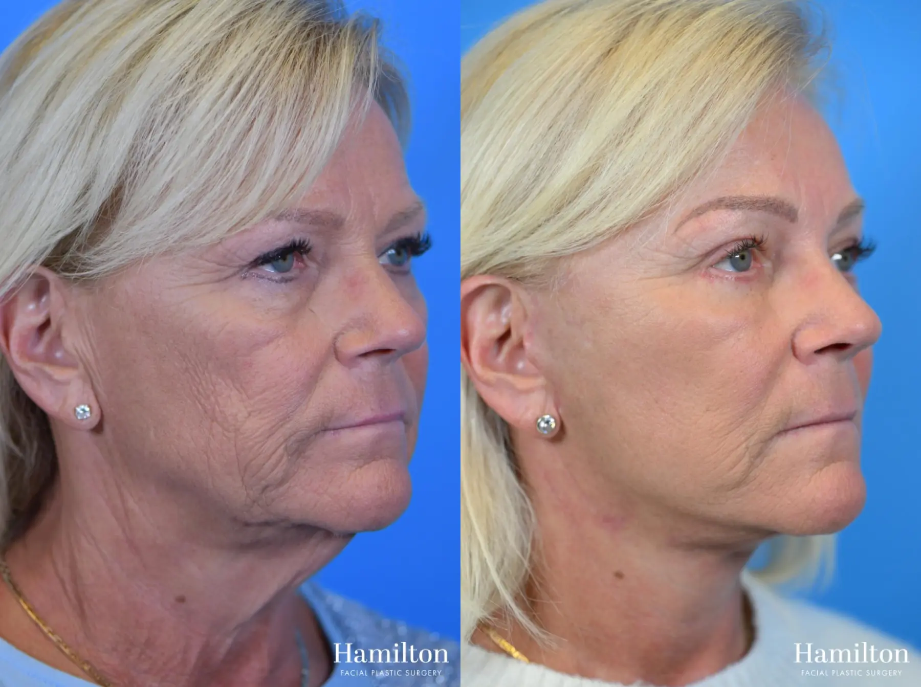 Facelift: Patient 11 - Before and After 4