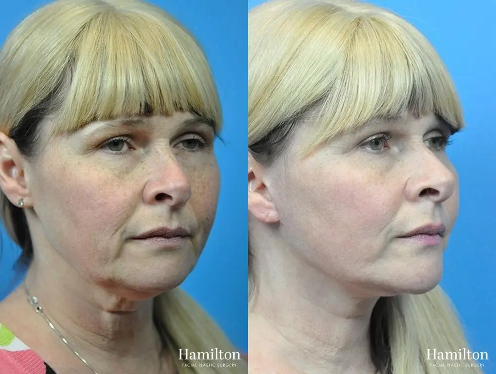 Facelift: Patient 22 - Before and After 1