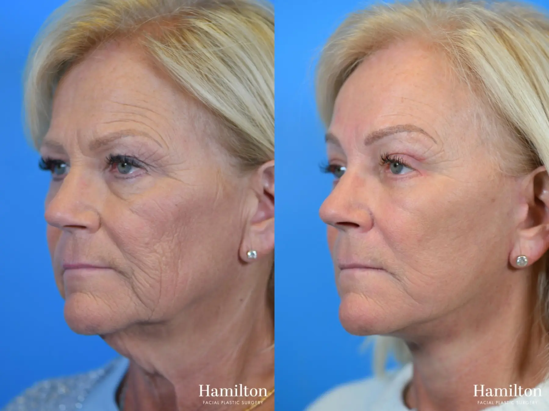 Facelift: Patient 11 - Before and After 1