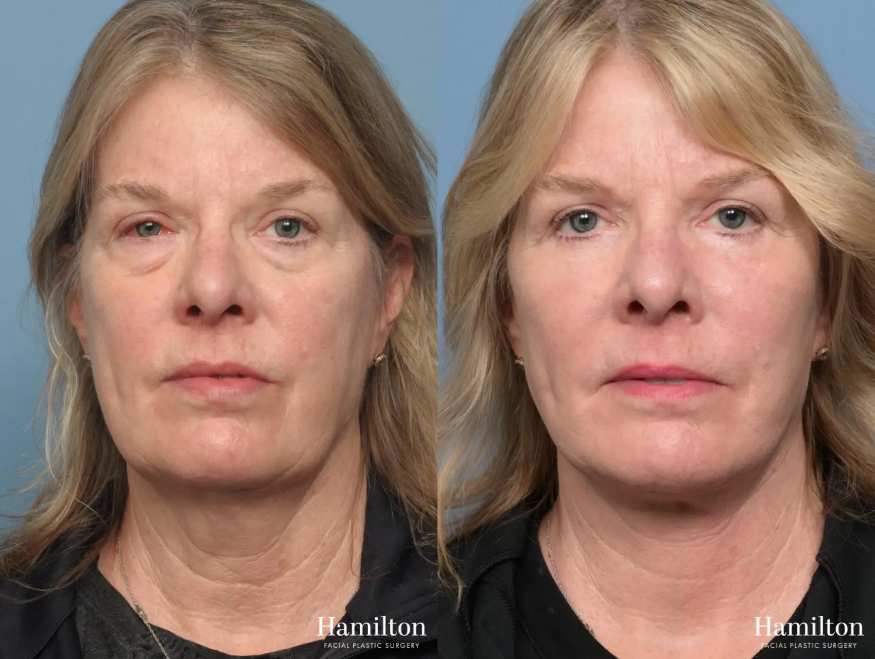 Facelift: Patient 43 - Before and After 4