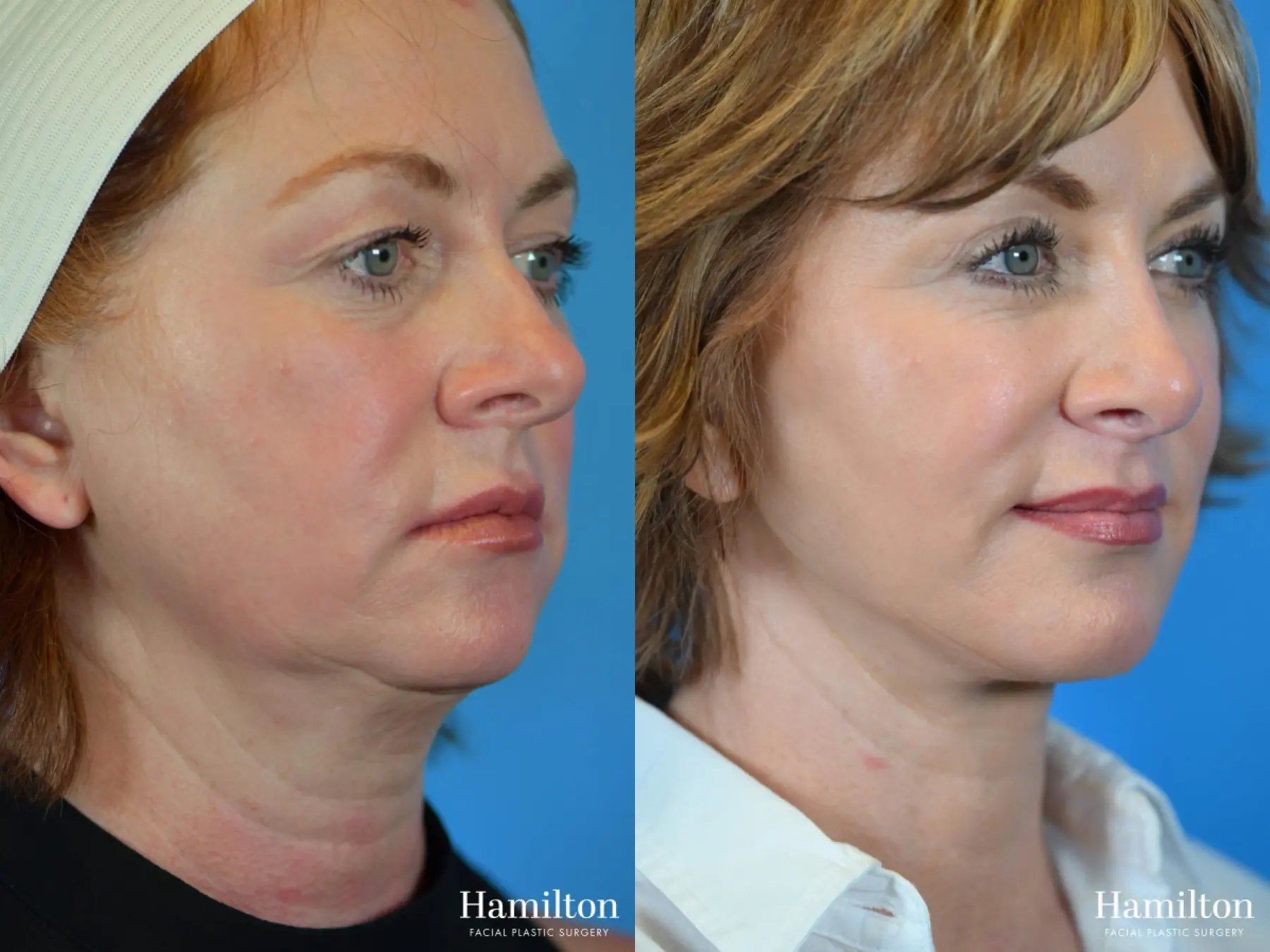 Facelift: Patient 1 - Before and After 3