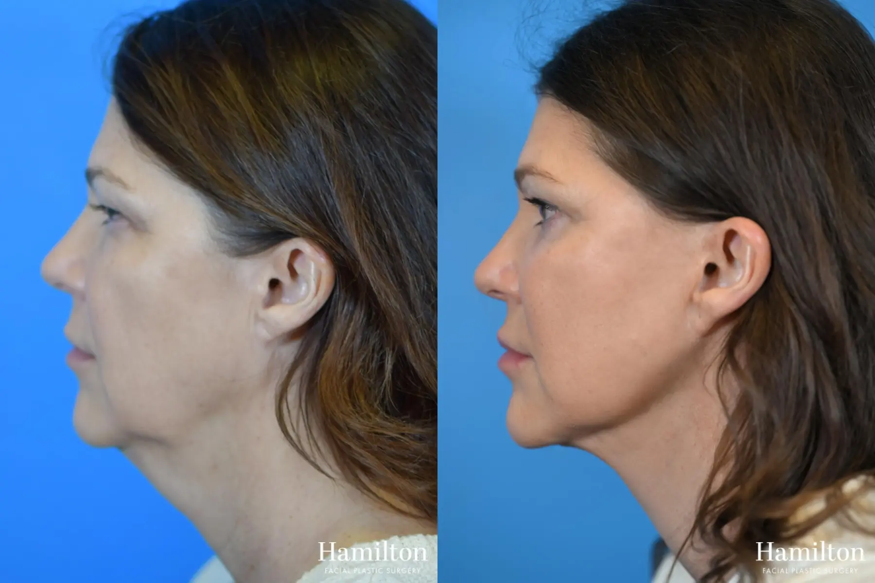 Facelift: Patient 15 - Before and After 4