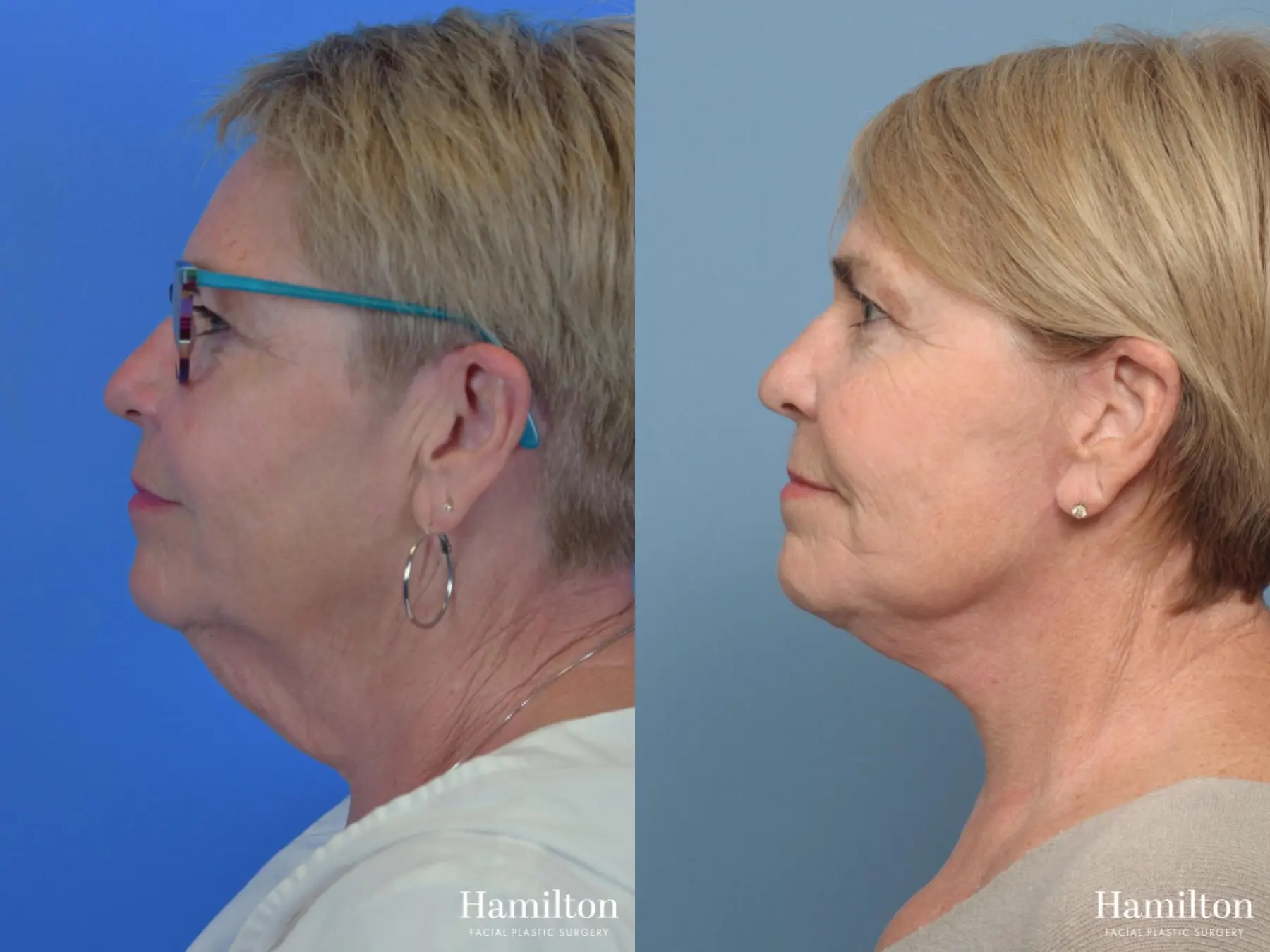 Facelift: Patient 18 - Before and After 1