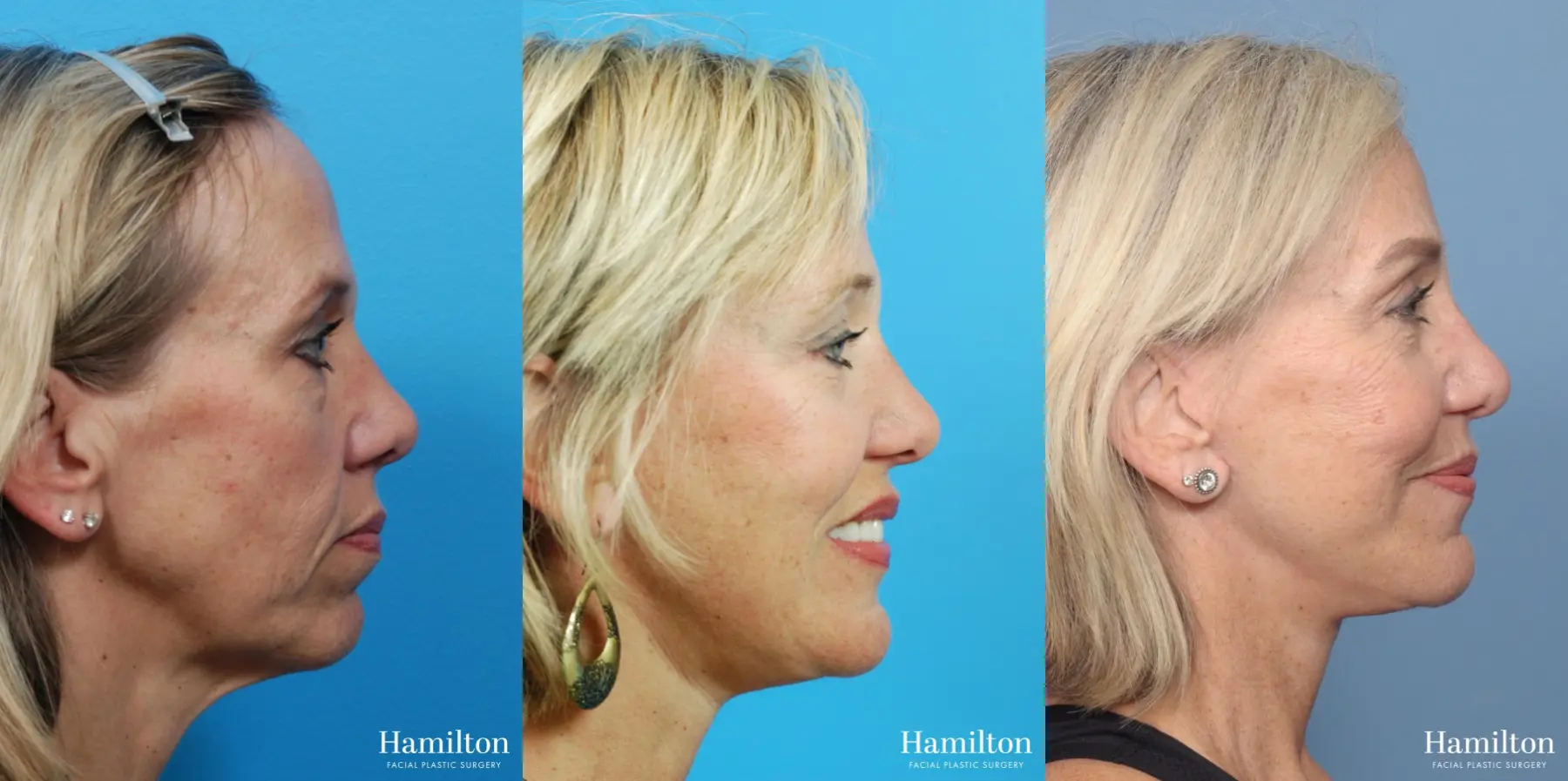 Facelift: Patient 17 - Before and After 3