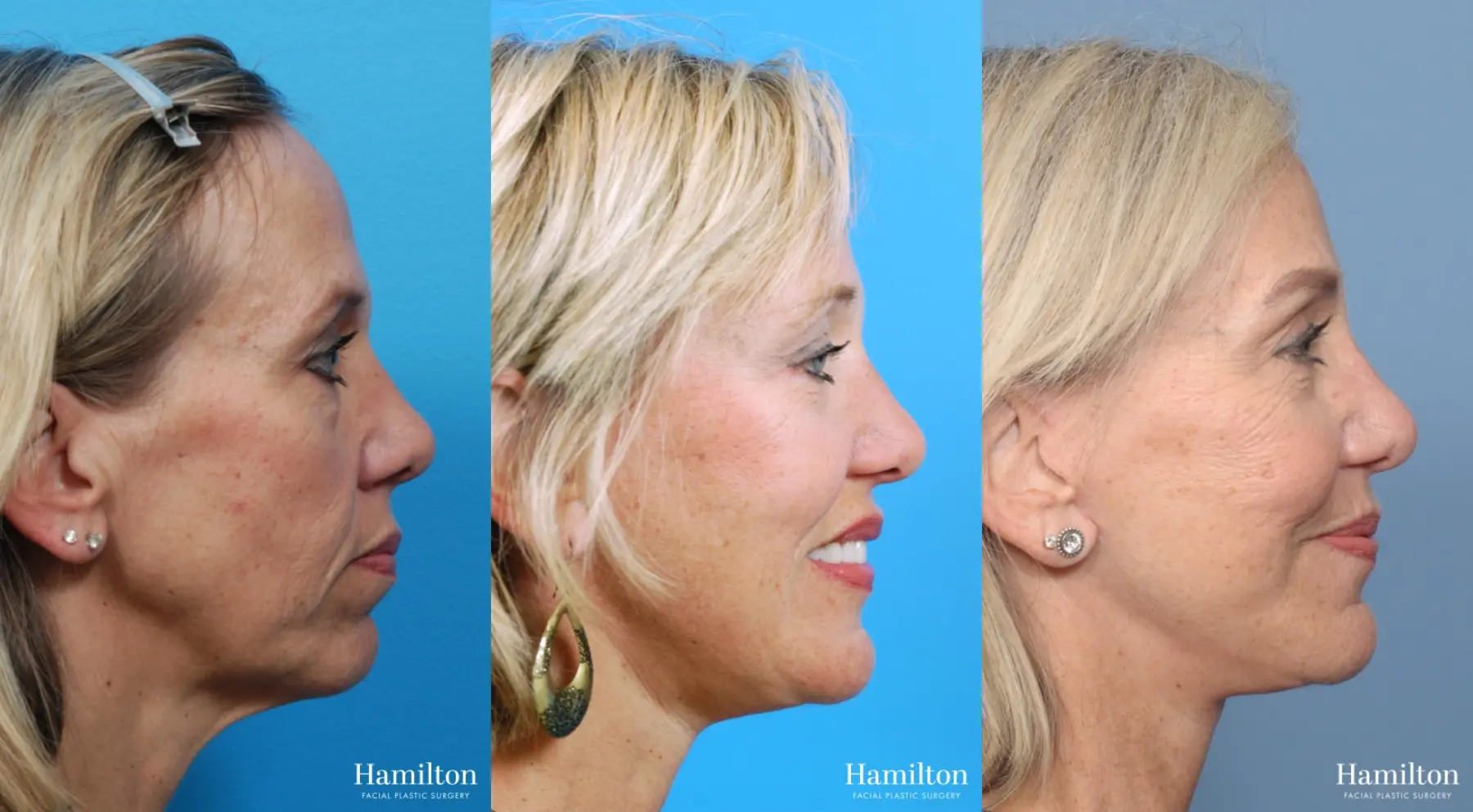 Facelift: Patient 17 - Before and After 3