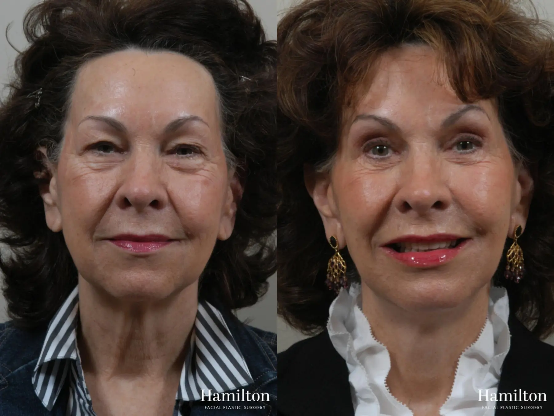 Facelift: Patient 26 - Before and After 1