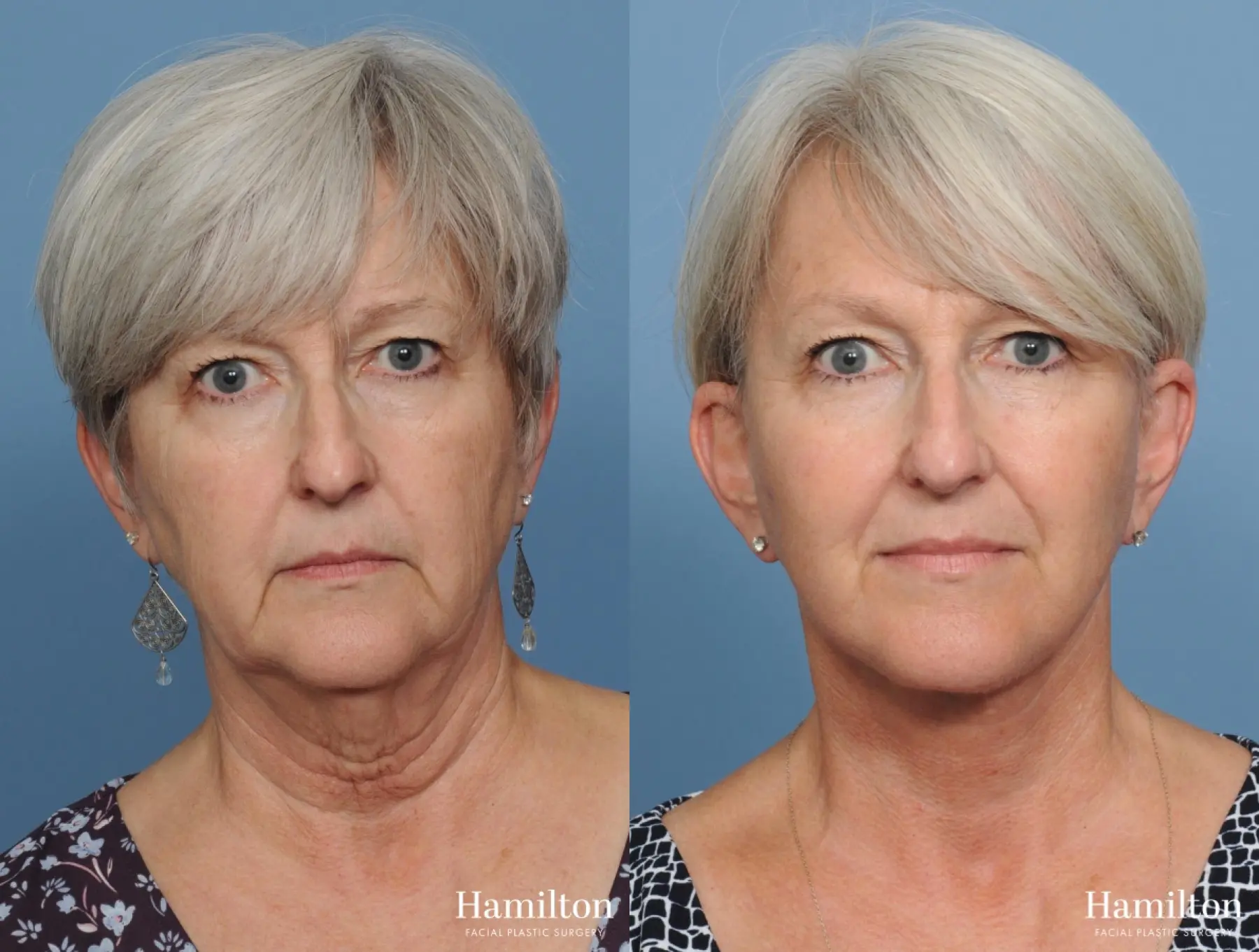 Facelift: Patient 4 - Before and After 2