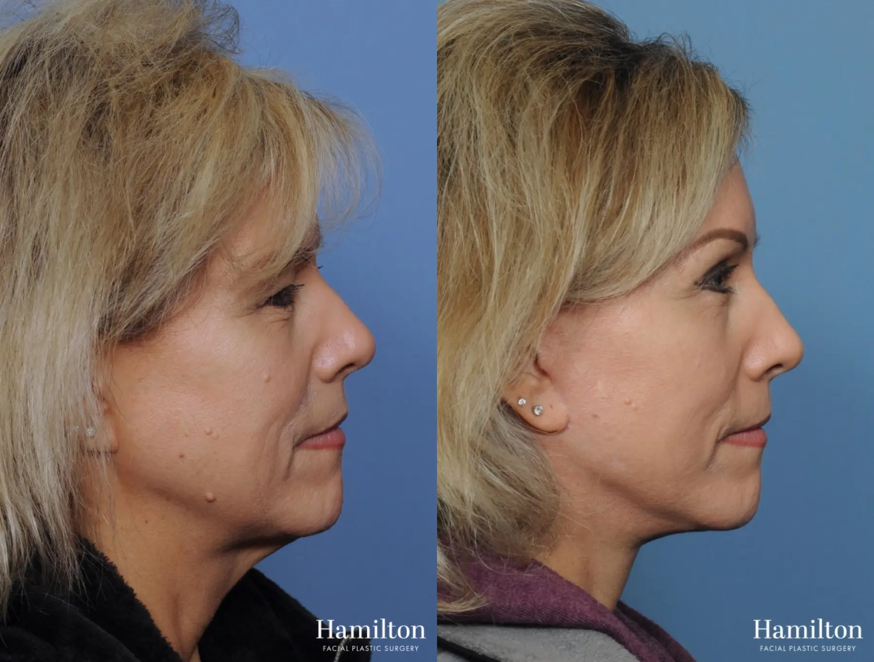 Facelift: Patient 1 - Before and After  