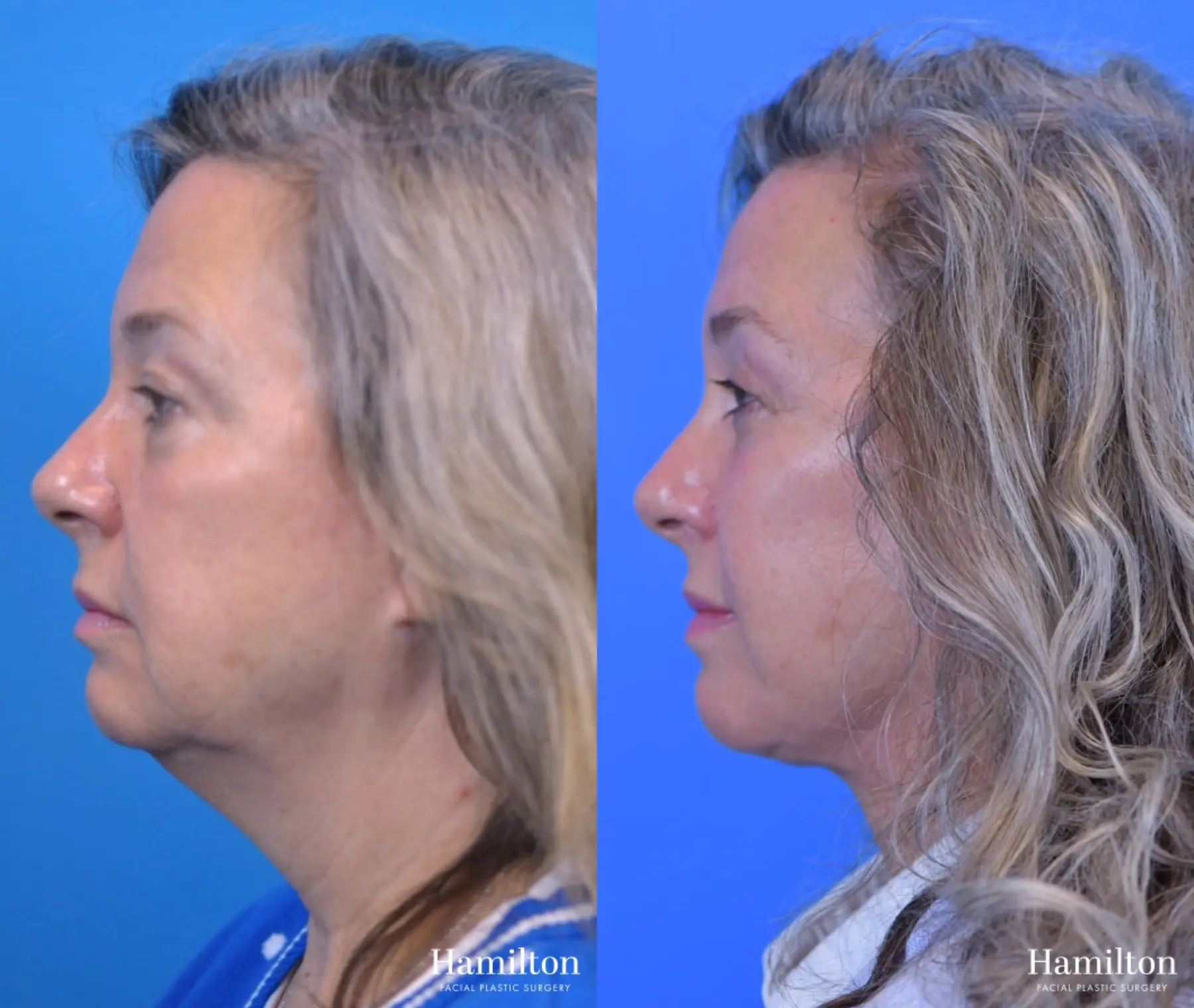 Facelift: Patient 15 - Before and After 4