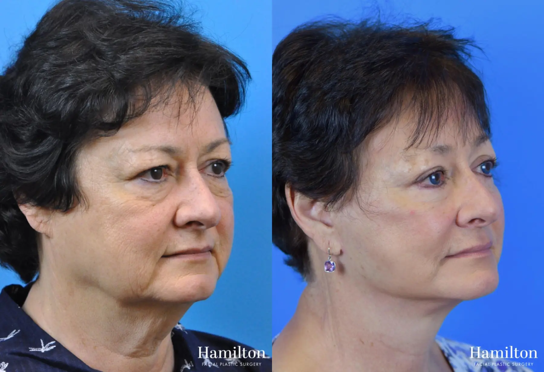 Facelift: Patient 14 - Before and After 3