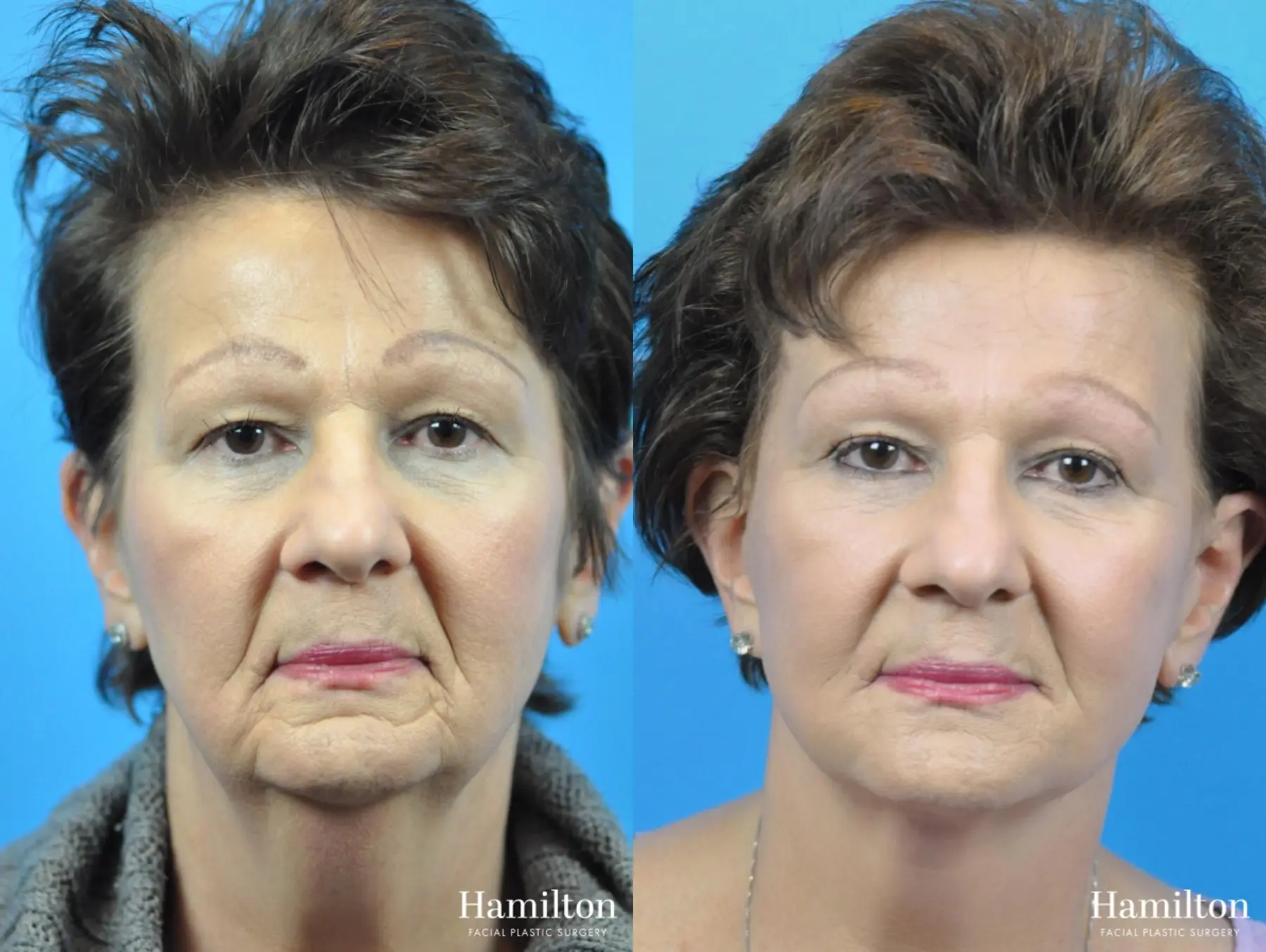 Facelift: Patient 24 - Before and After 2