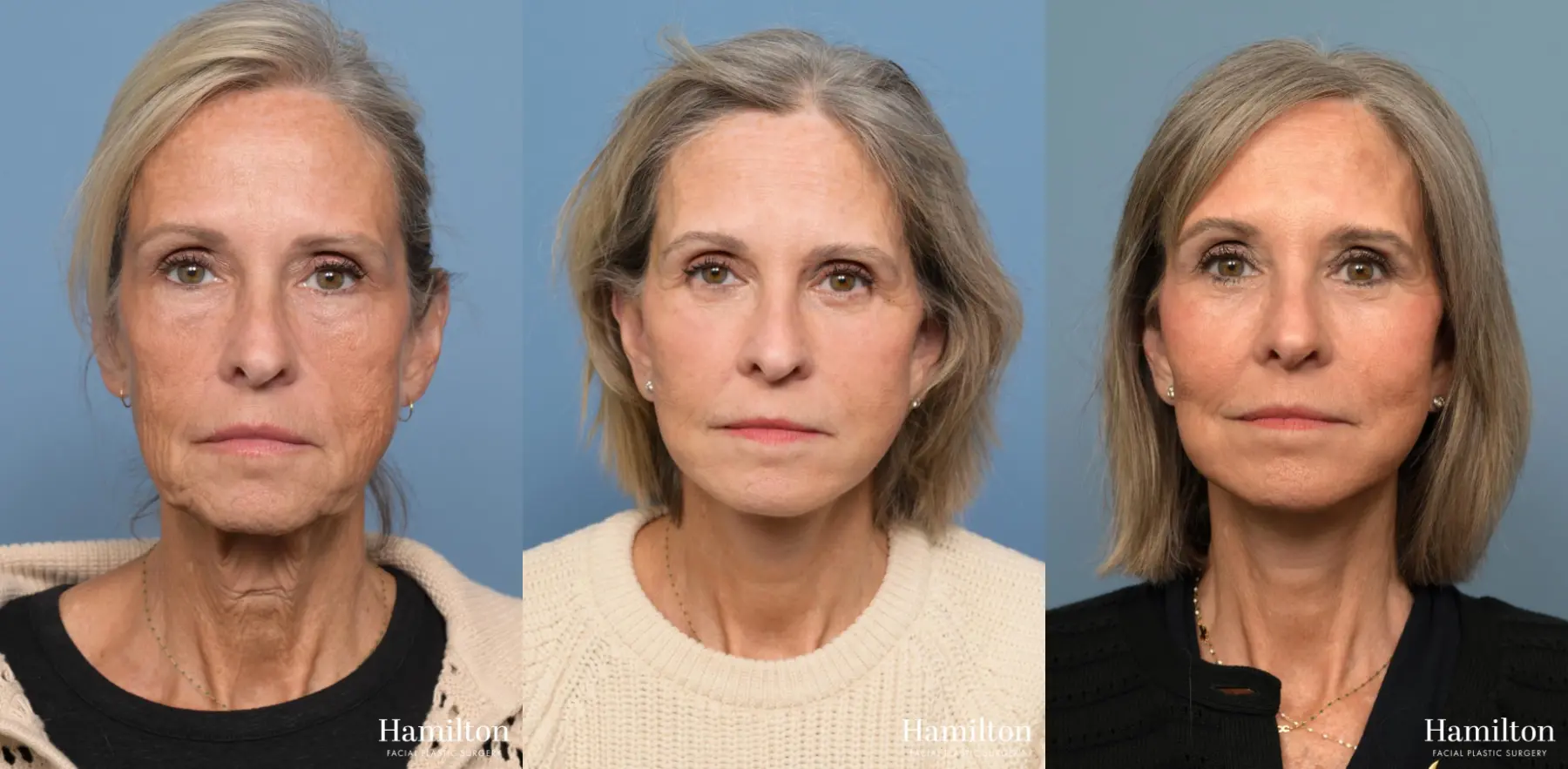 Facelift: Patient 8 - Before and After 1