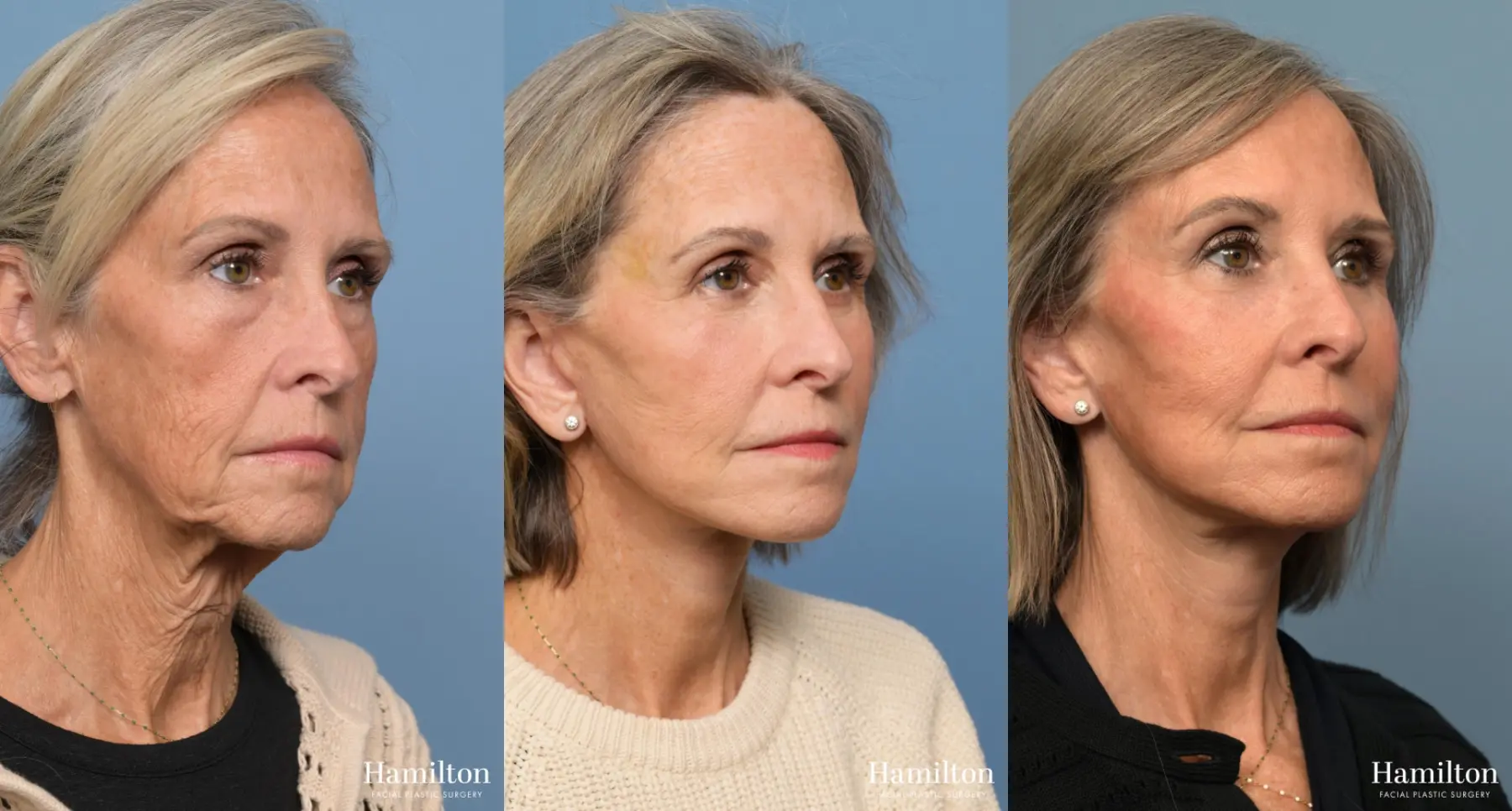 Facelift: Patient 8 - Before and After 2