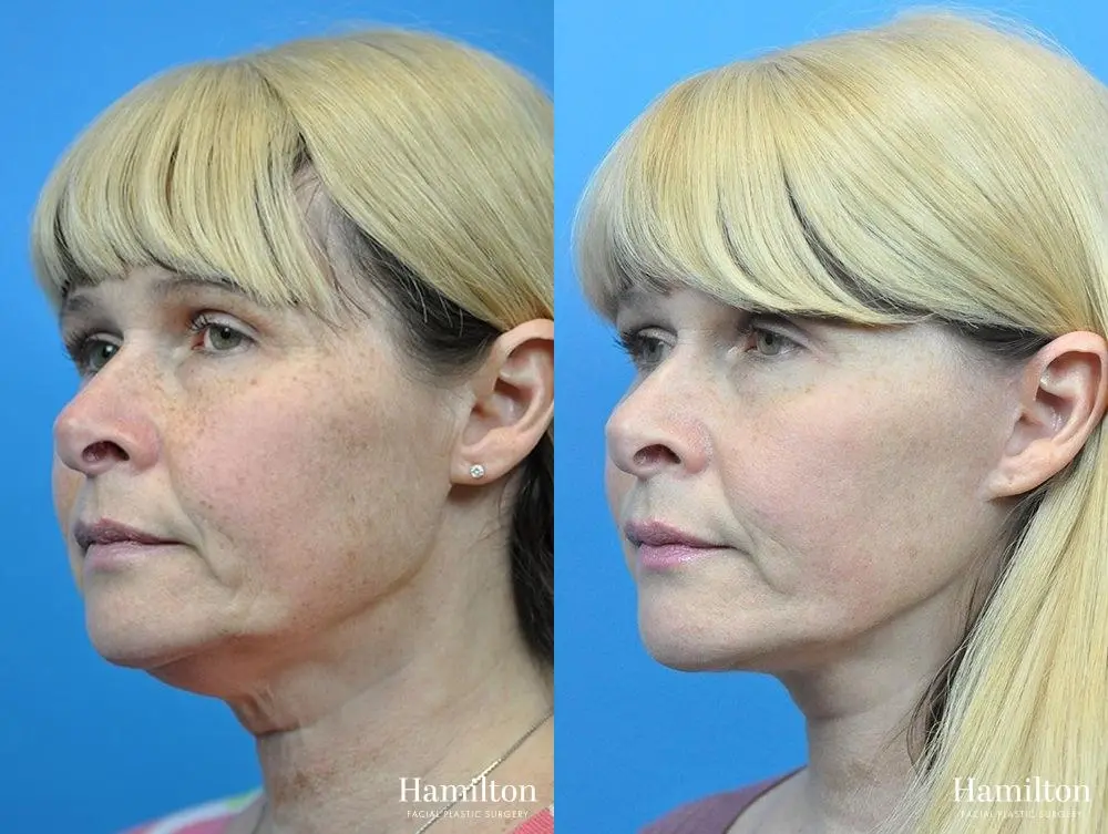 Facelift: Patient 22 - Before and After 2