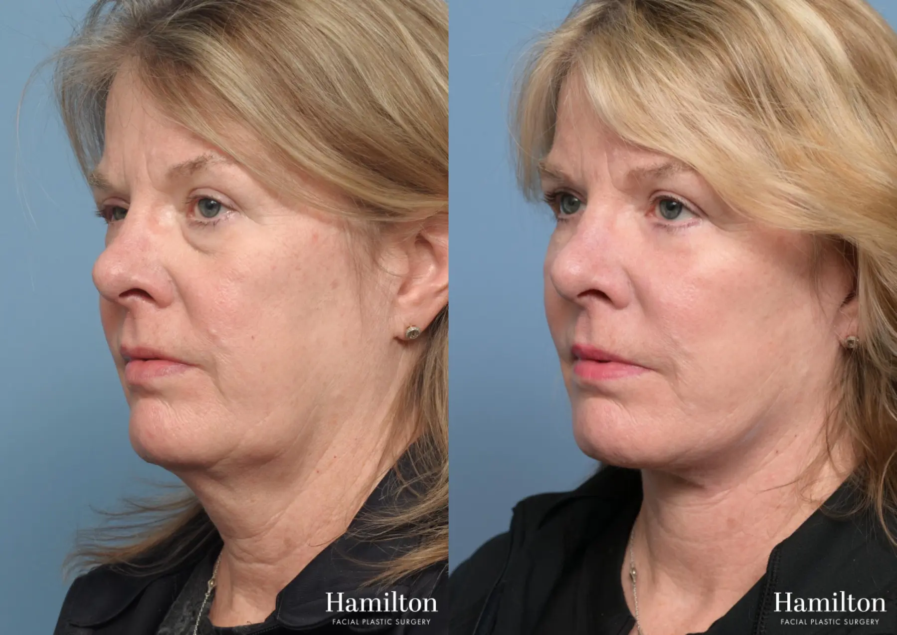 Facelift: Patient 43 - Before and After 3
