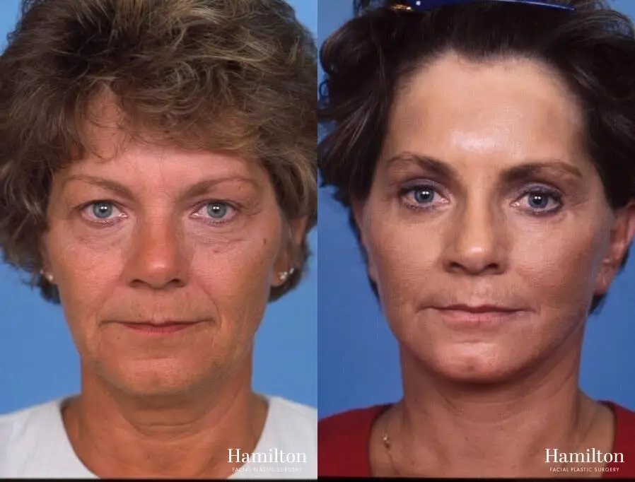 Facelift: Patient 27 - Before and After 1