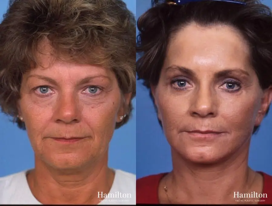 Facelift: Patient 40 - Before and After 1