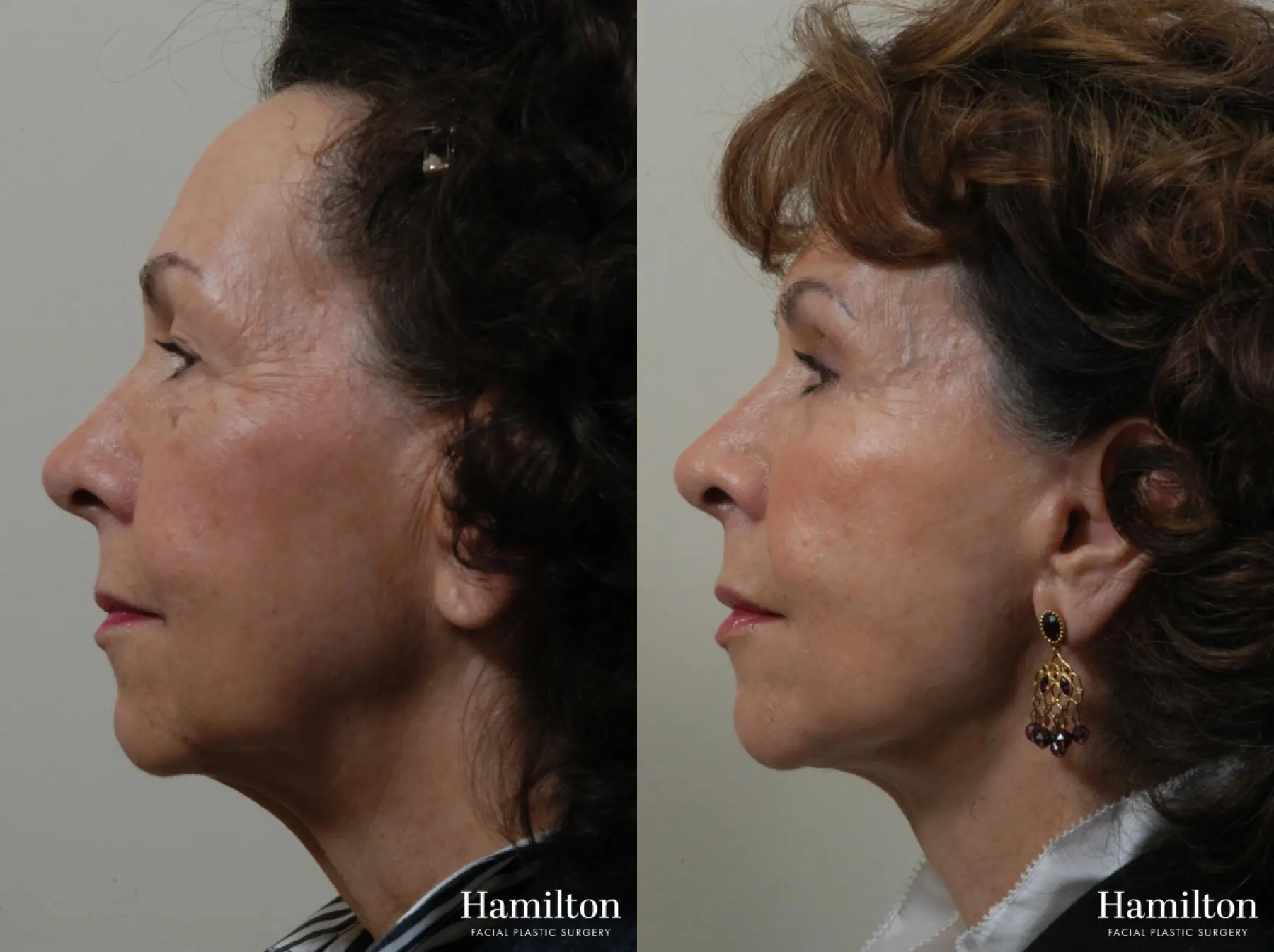 Facelift: Patient 26 - Before and After 3