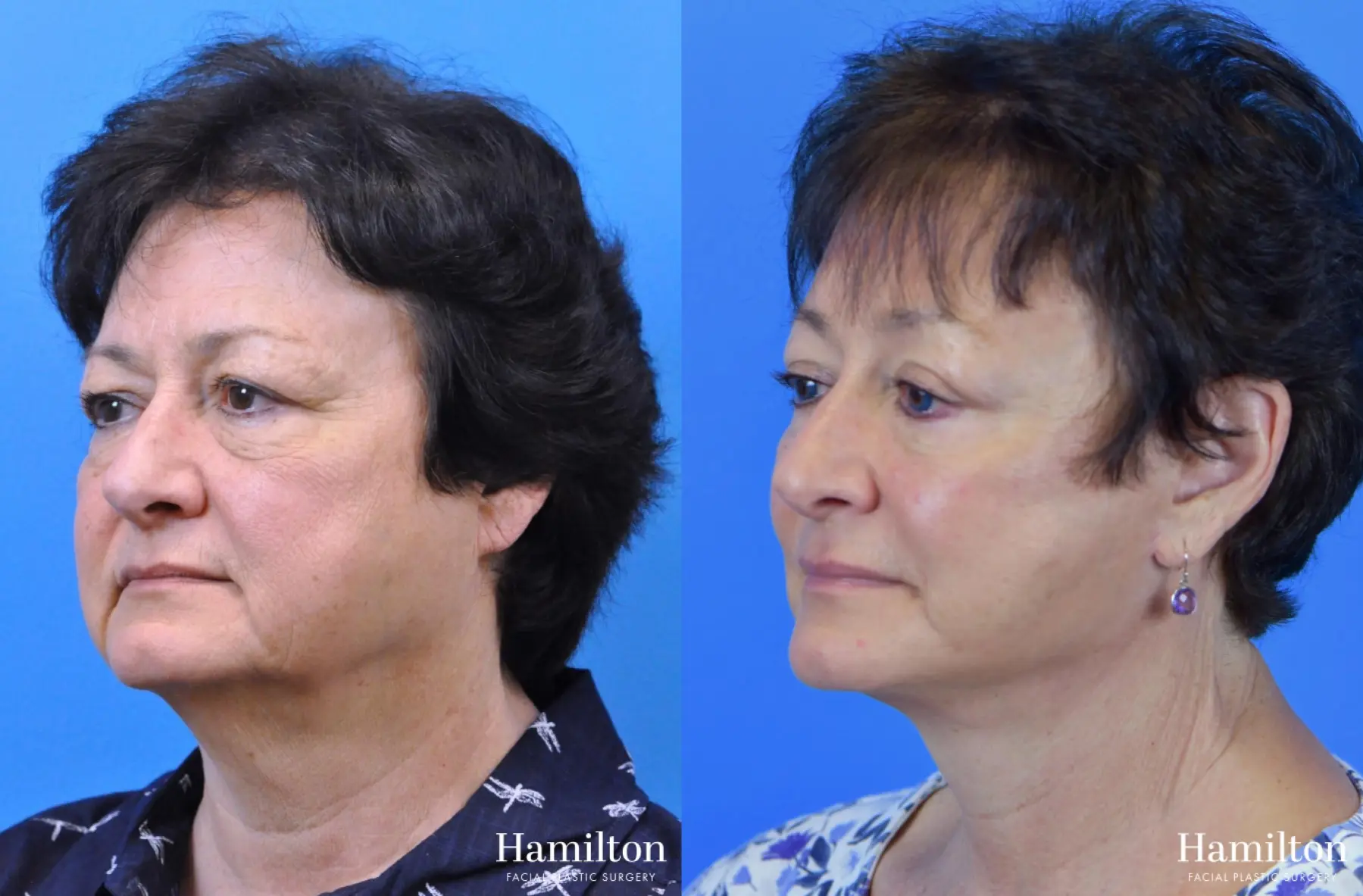 Facelift: Patient 27 - Before and After 4