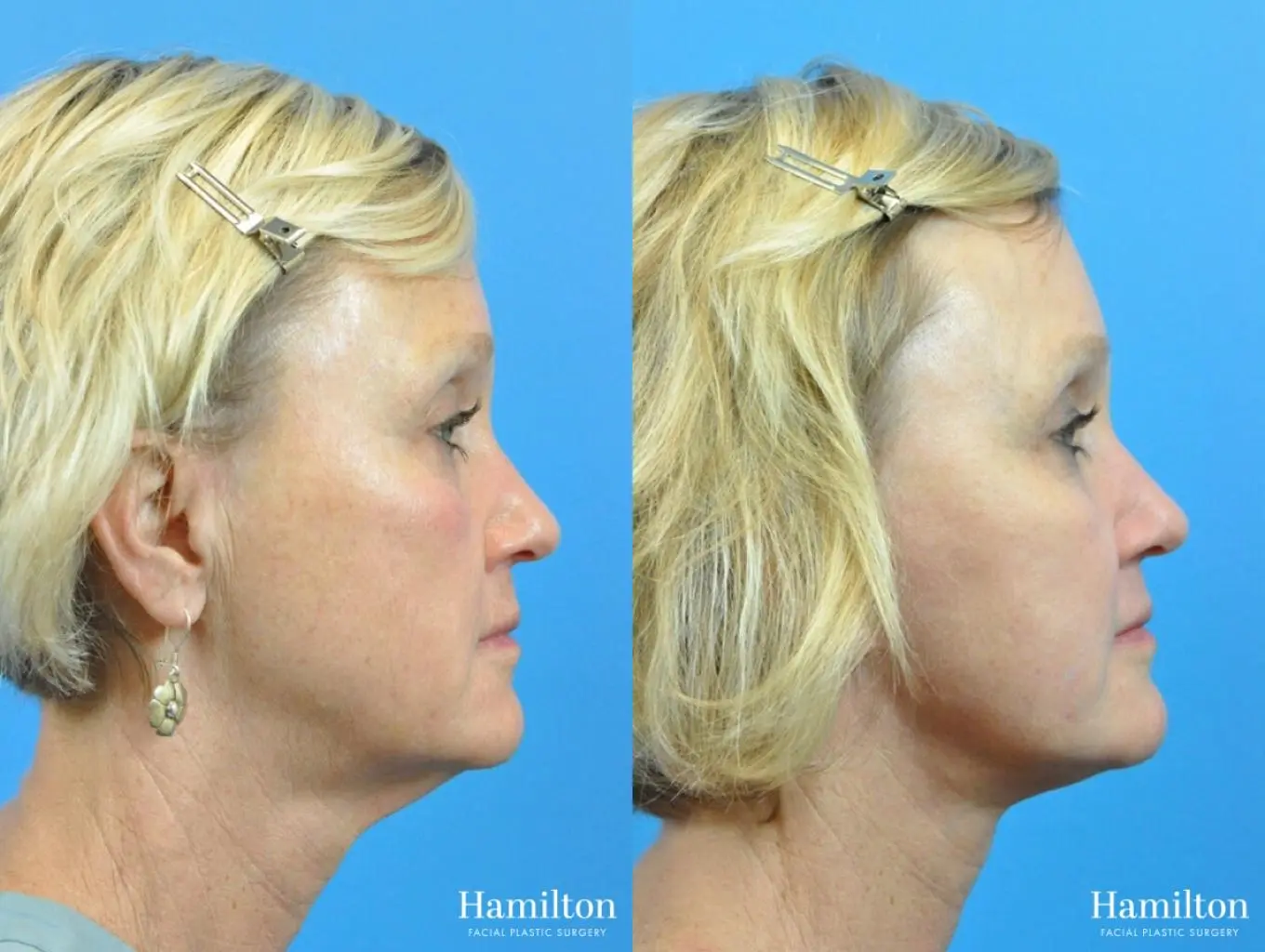 Facelift: Patient 25 - Before and After 3