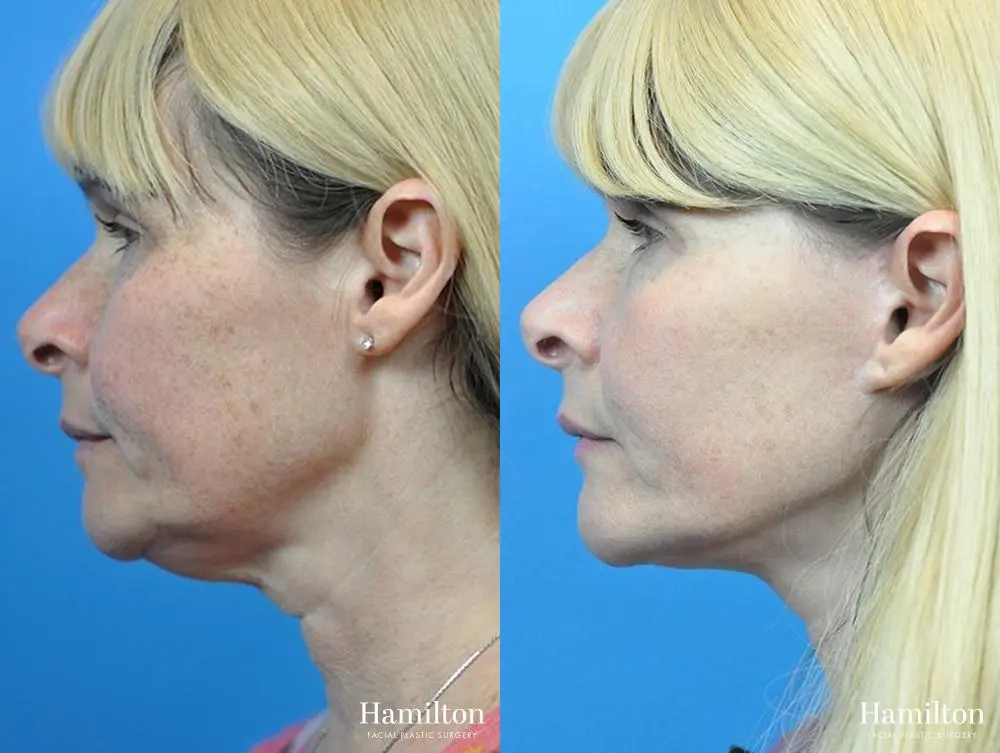 Facelift: Patient 22 - Before and After 4