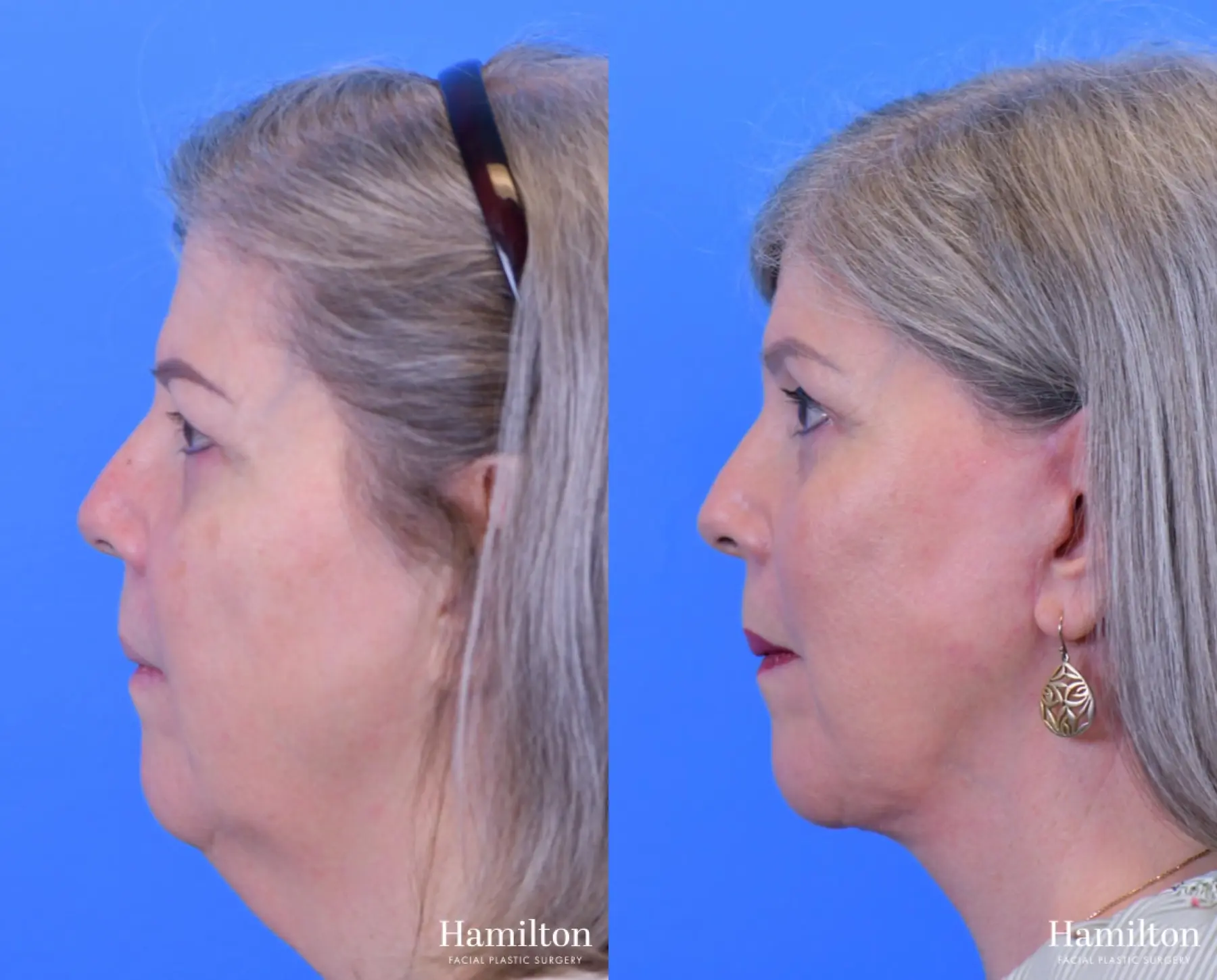 Facelift: Patient 17 - Before and After 2