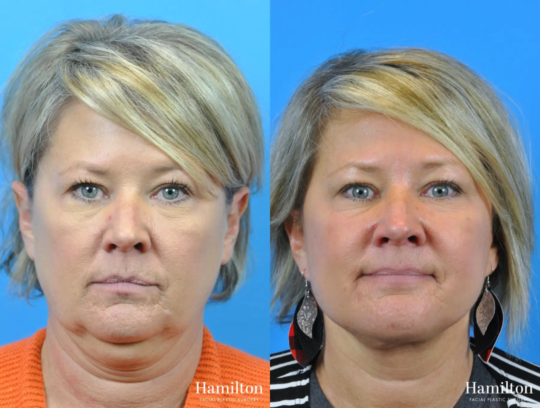 Facelift: Patient 7 - Before and After 3