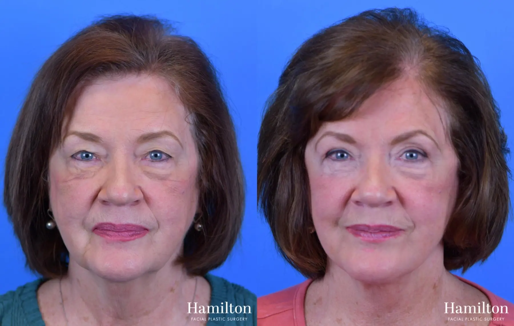 Facelift: Patient 29 - Before and After 2