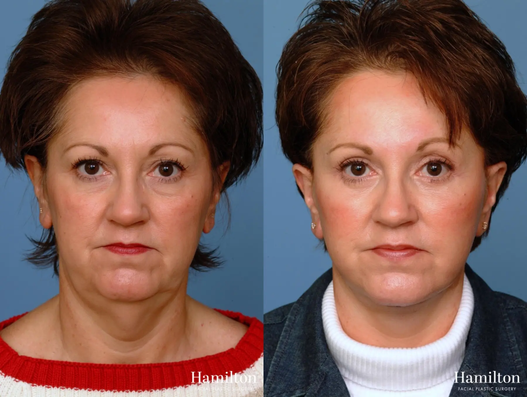 Facelift: Patient 13 - Before and After 3