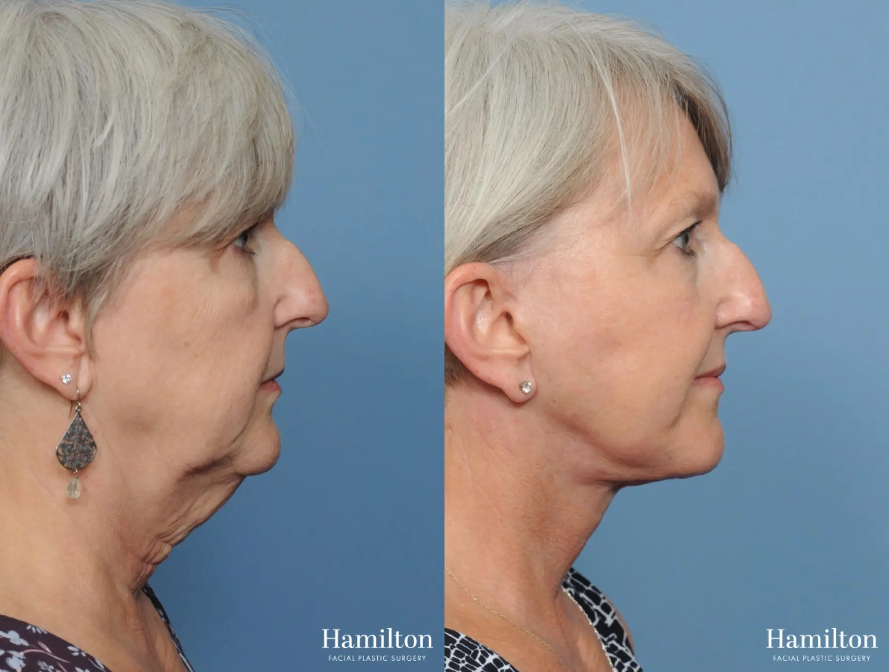 Facelift: Patient 4 - Before and After 1