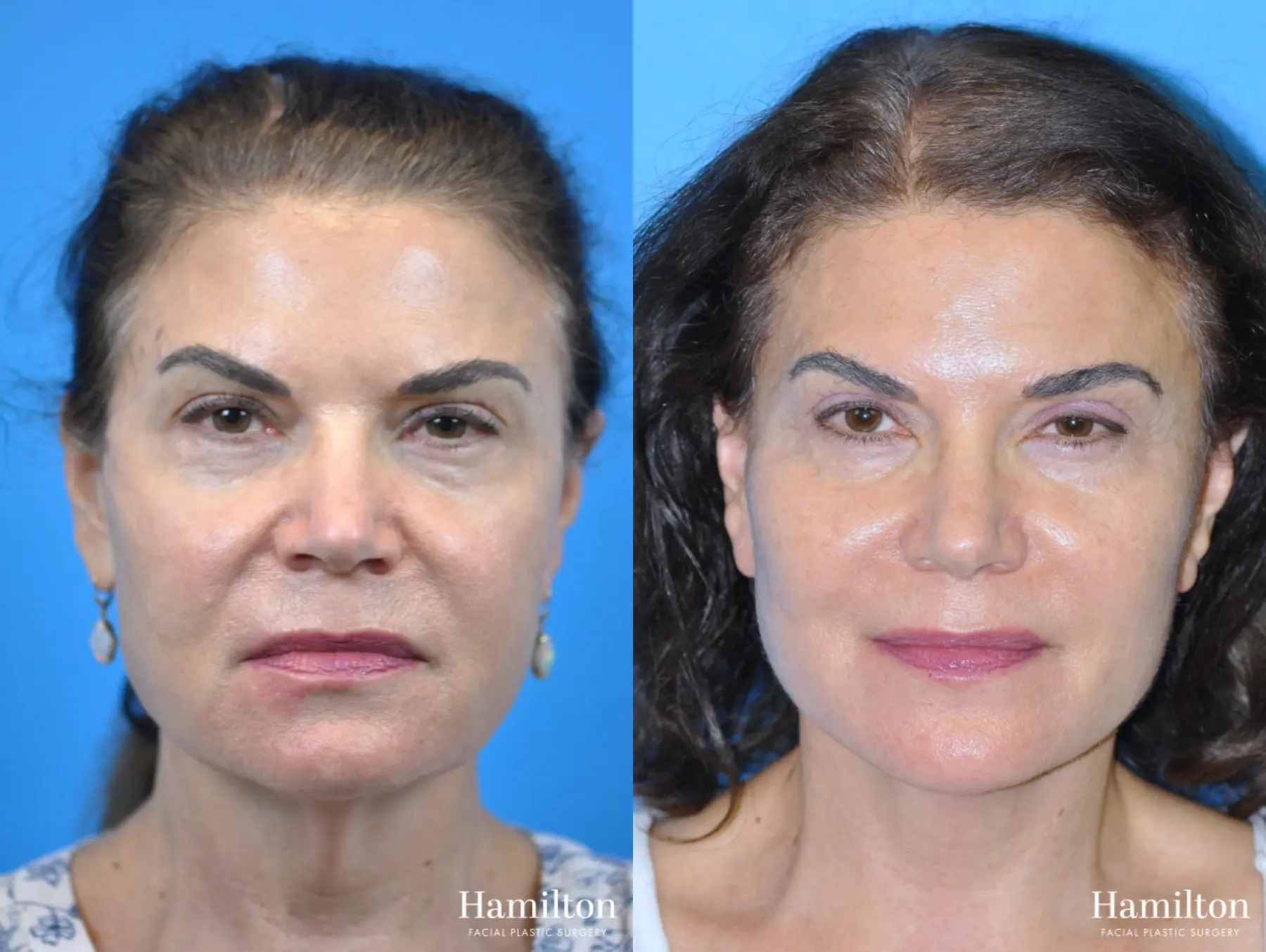 Facelift: Patient 2 - Before and After 2