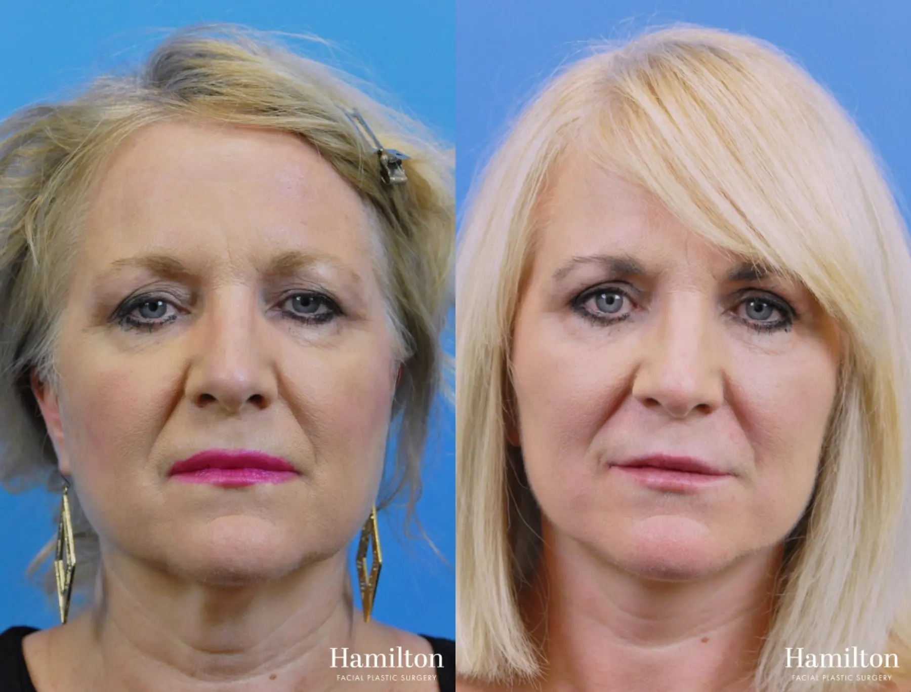 Facelift: Patient 10 - Before and After 4