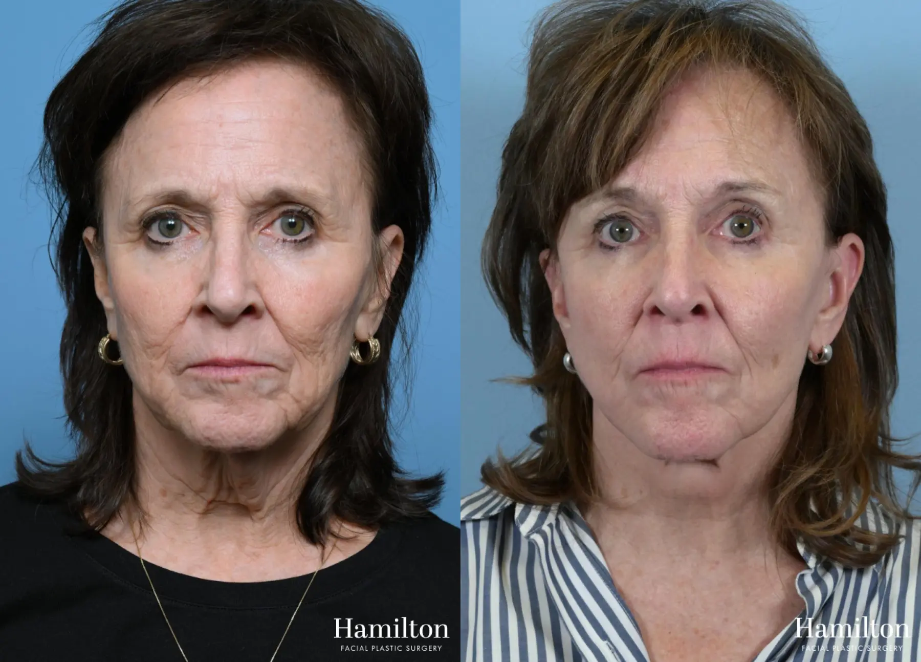 Facelift: Patient 40 - Before and After 5
