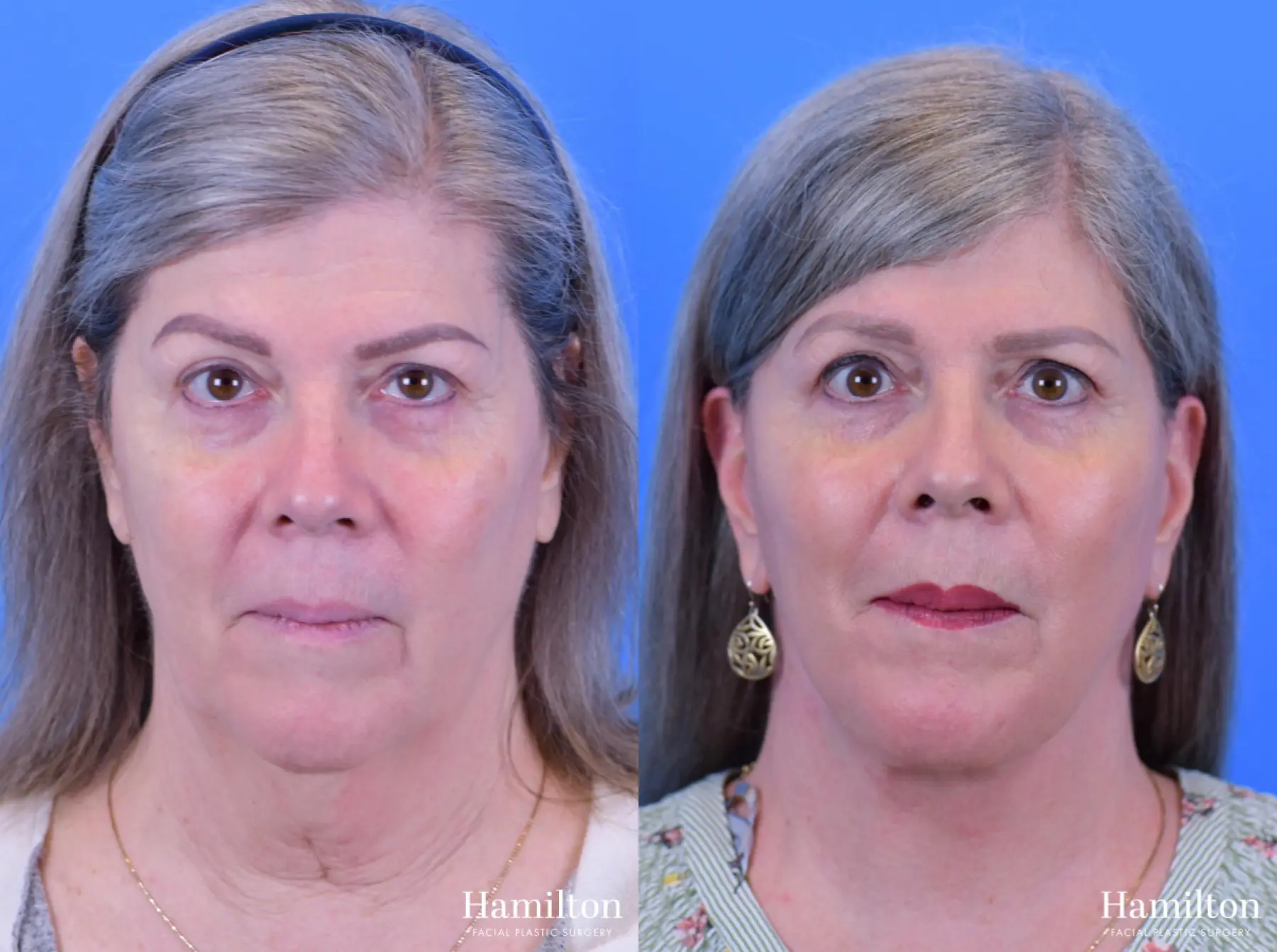 Facelift: Patient 17 - Before and After 3