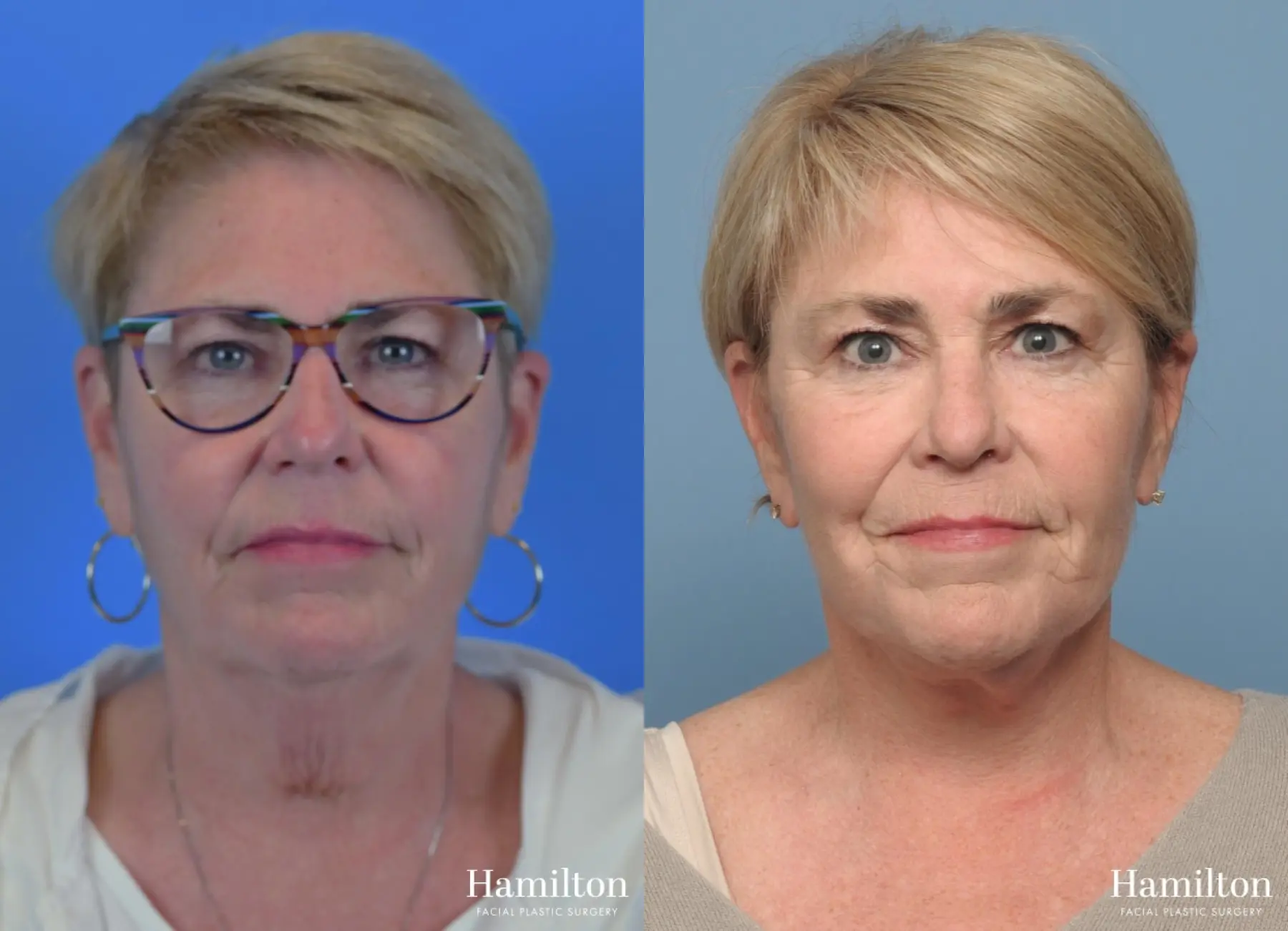 Facelift: Patient 18 - Before and After 4