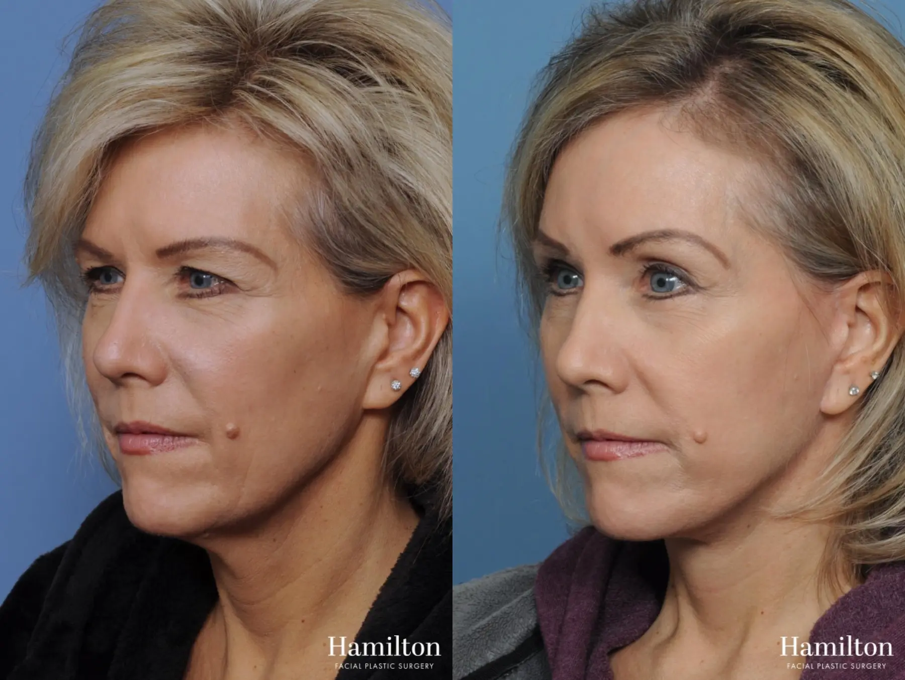 Facelift: Patient 3 - Before and After 5