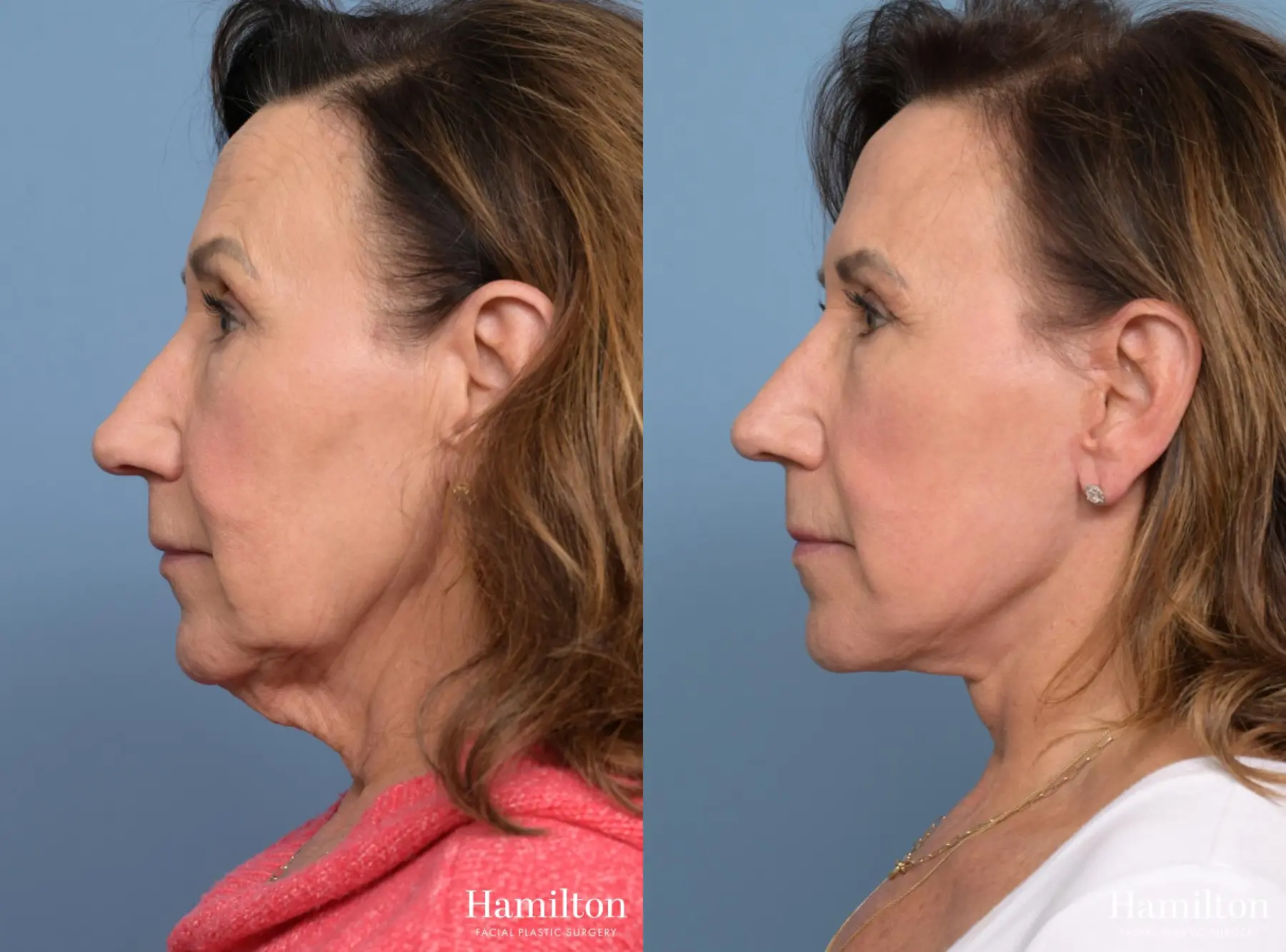 Facelift: Patient 9 - Before and After 1