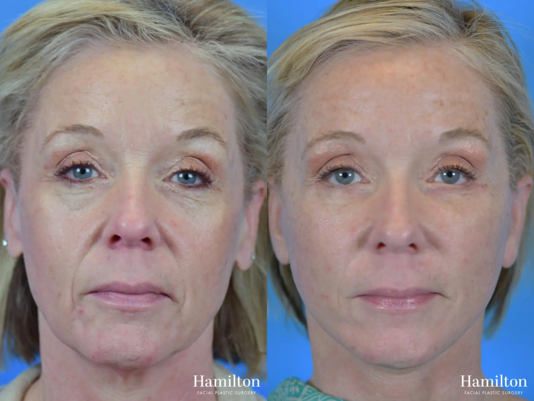 Facelift: Patient 37 - Before and After 1