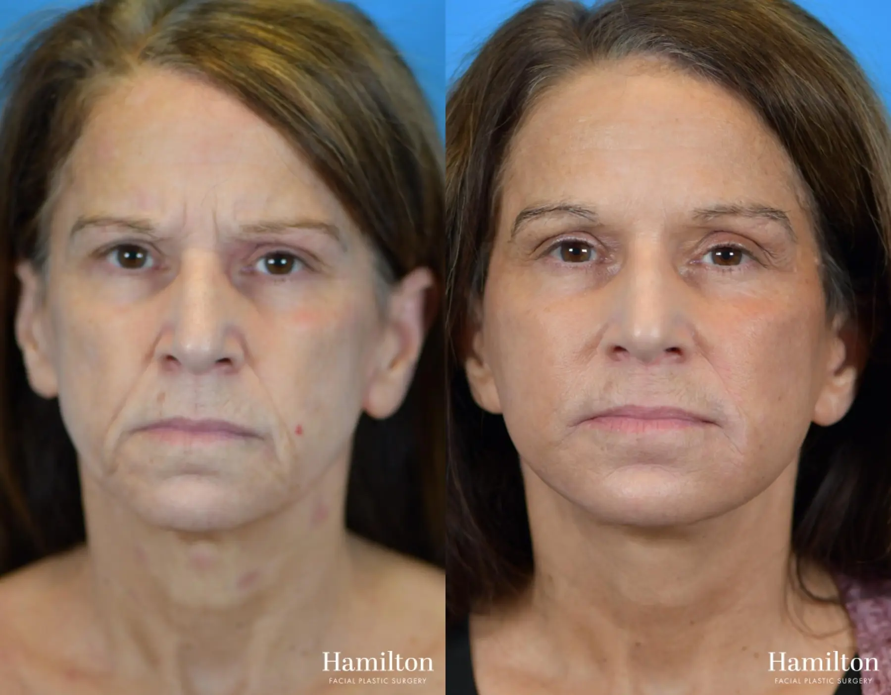 Facelift: Patient 18 - Before and After 4