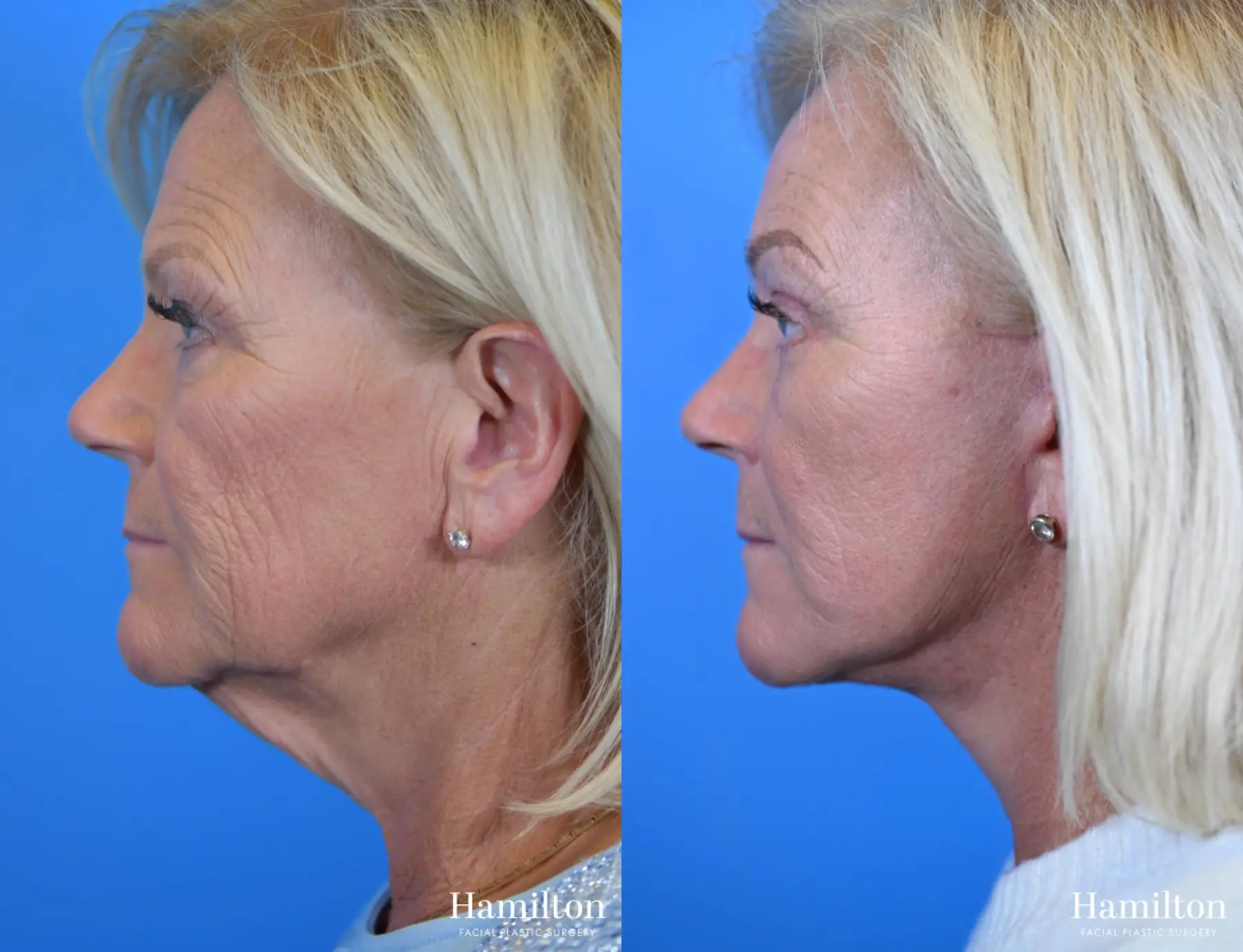 Facelift: Patient 11 - Before and After 3
