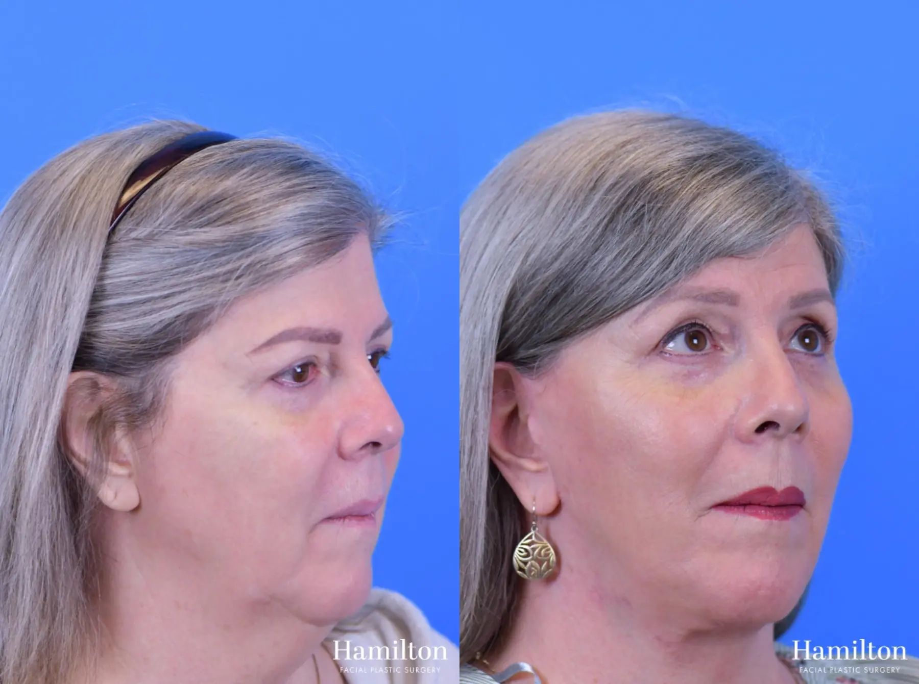 Facelift: Patient 17 - Before and After 5