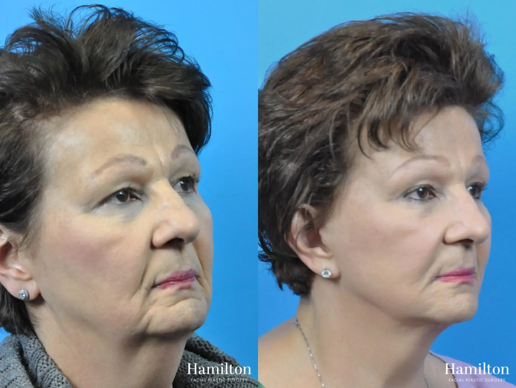 Facelift: Patient 24 - Before and After 3