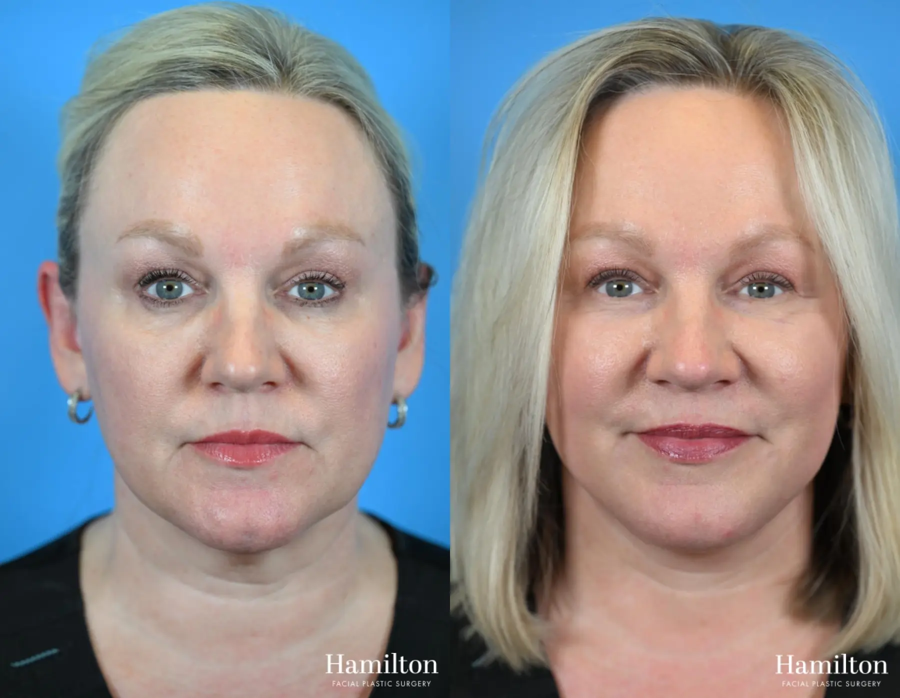 Facelift: Patient 36 - Before and After 5