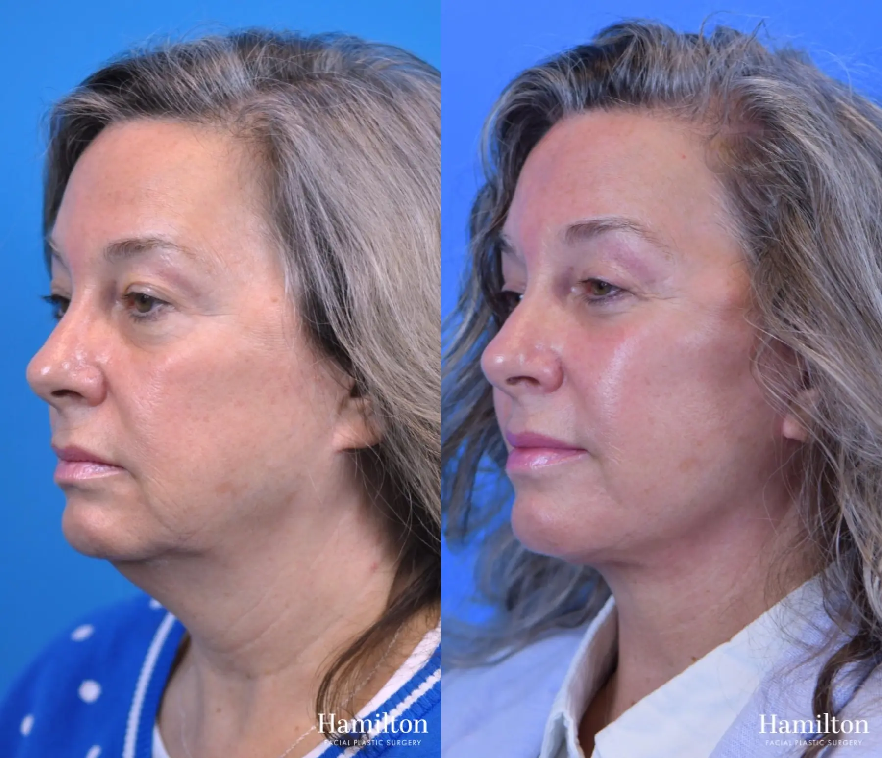 Facelift: Patient 25 - Before and After 2