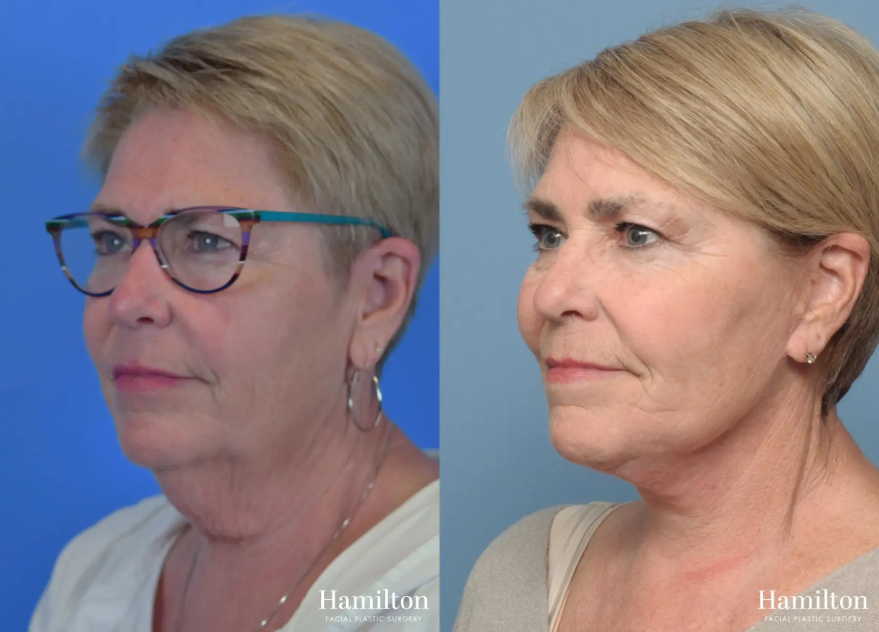 Facelift: Patient 18 - Before and After 3