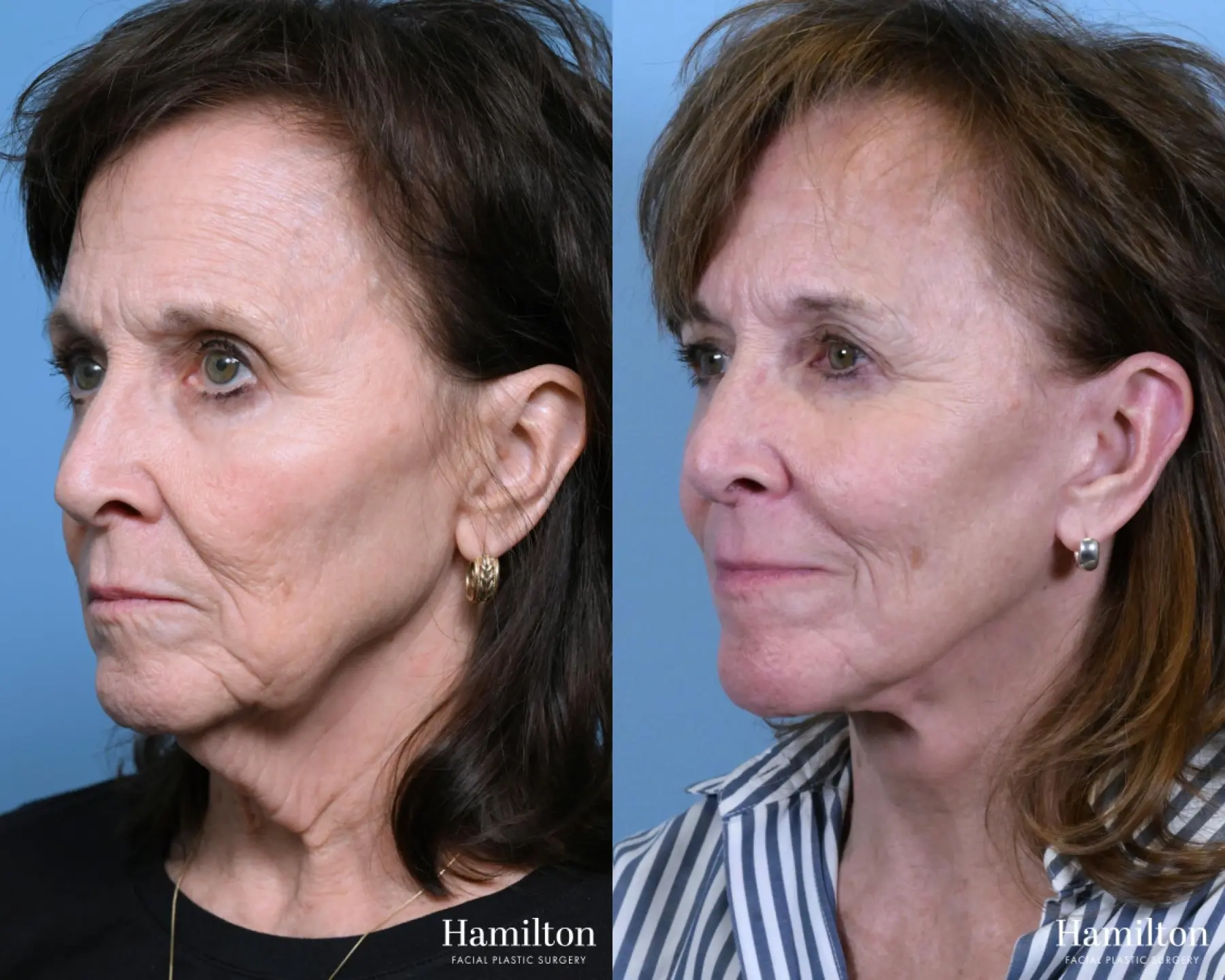 Facelift: Patient 40 - Before and After 3