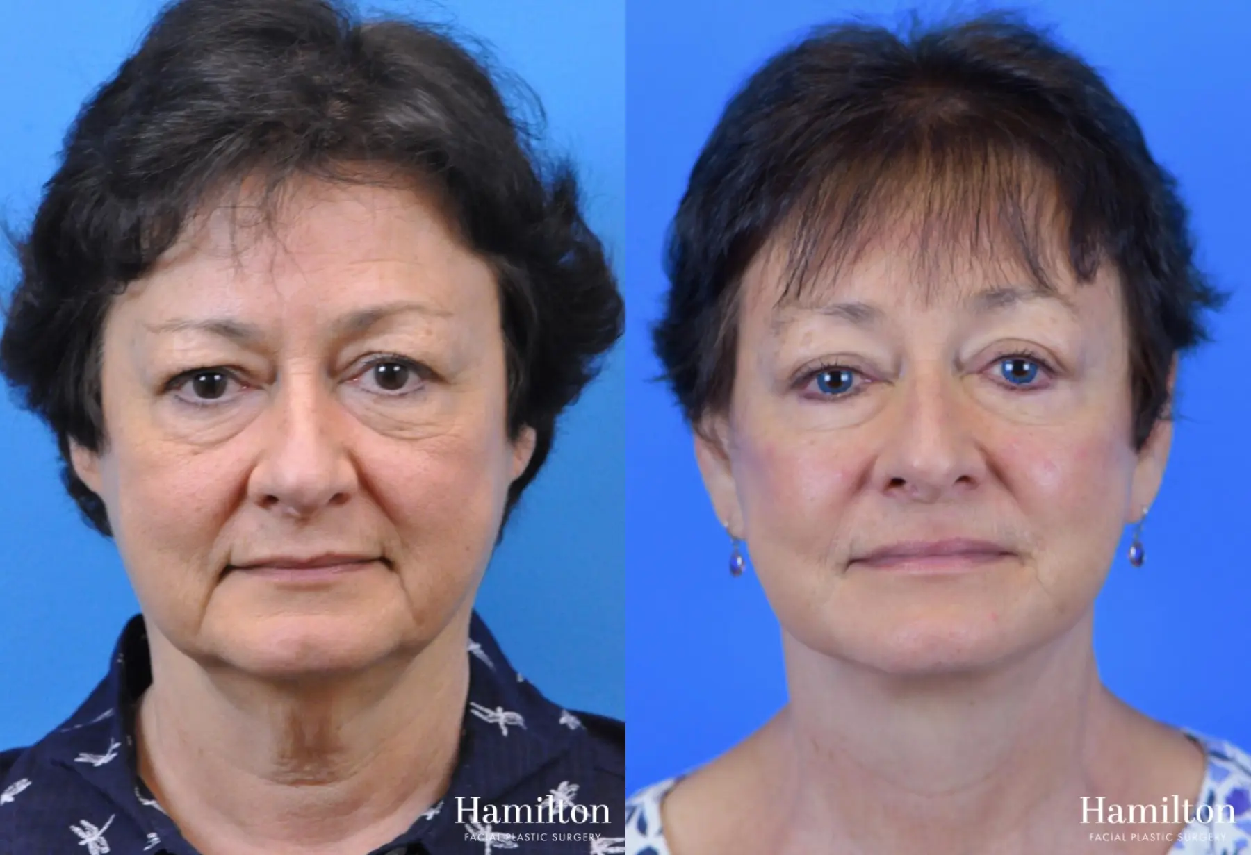 Facelift: Patient 27 - Before and After 2