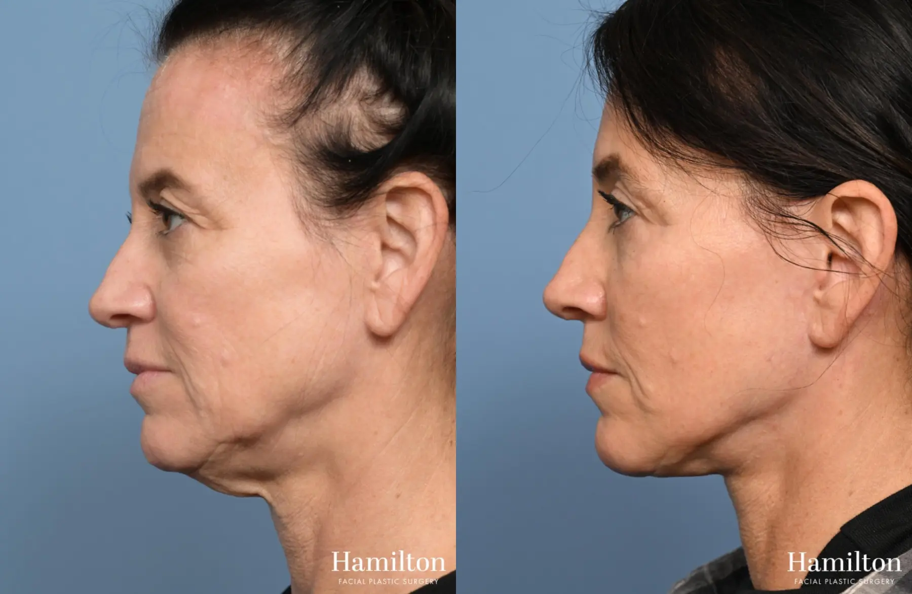Facelift: Patient 29 - Before and After 5
