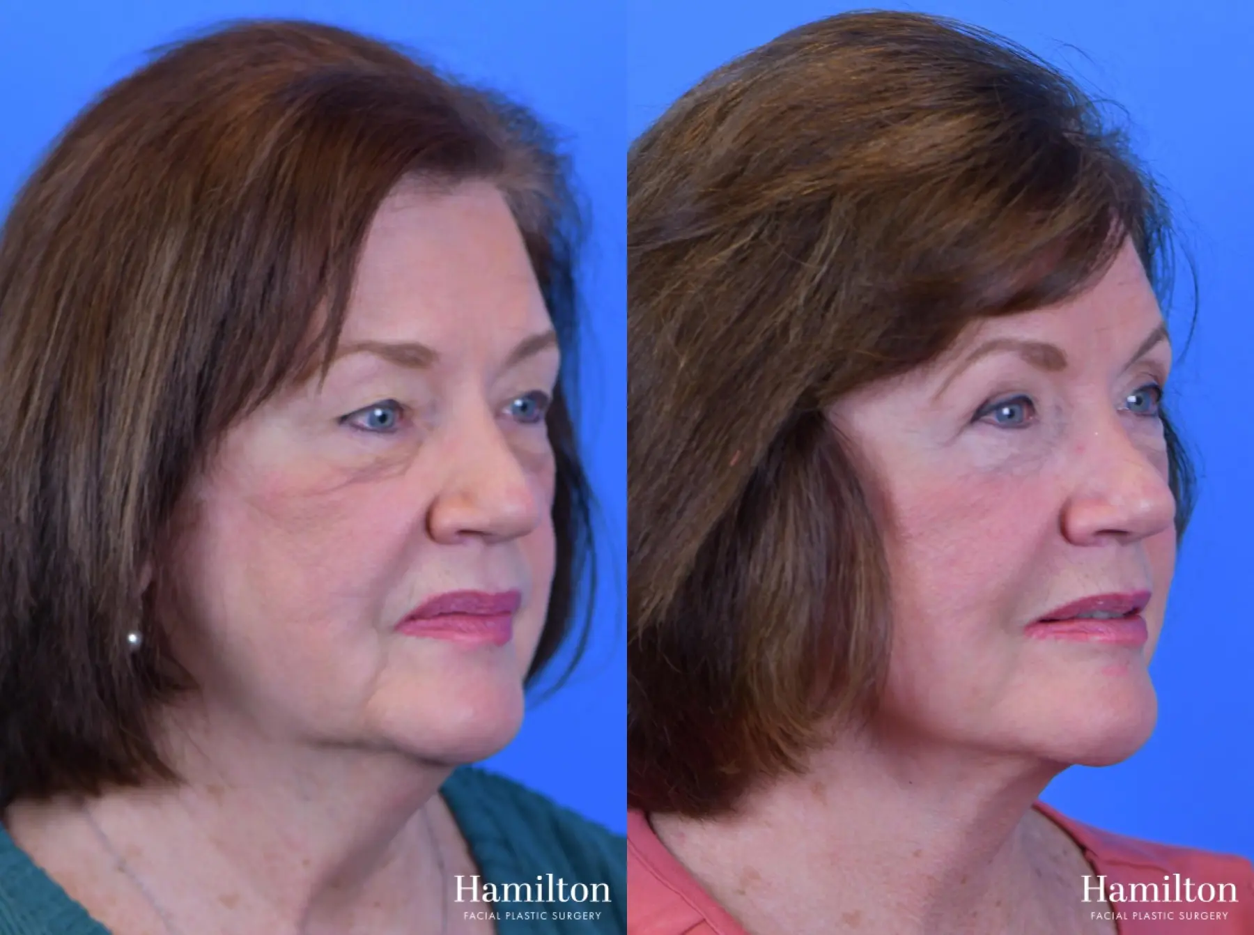 Facelift: Patient 16 - Before and After 3