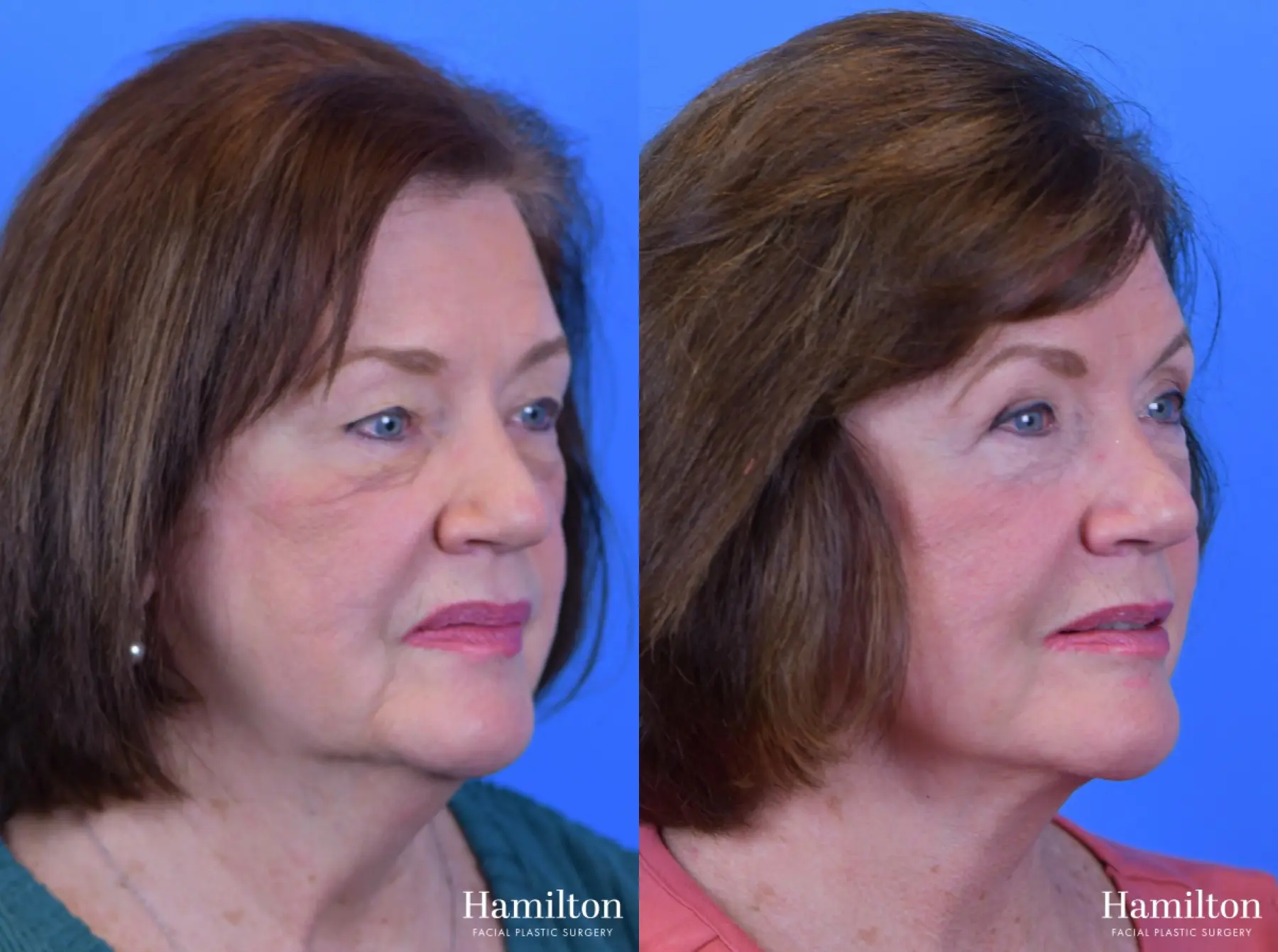 Facelift: Patient 29 - Before and After 3